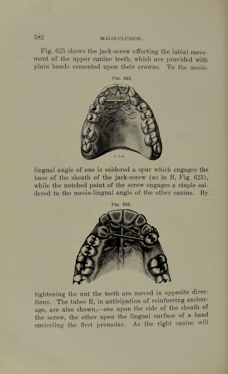 Fig. 625 shows the jack-screw effecting the labial move- ment of the upper canine teeth, which are provided with plain bands cemented upon their crowns. To the mesio- FiQ. 625. lingual angle of one is soldered a spur which engages the base of the sheath of the jack-screw (as in B, Fig. 623), while the notched point of the screw engages a staple sol- dered to the mesio-lingual angle of the other canine. By Fig. 626. tightening the nut the teeth are moved in opposite direc- tions. The tubes R, in anticipation of reinforcing anchor- age, are also shown,—one upon the side of the sheath of the screw, the other upon the lingual surface of a band encircling the first premolar. As the right canine will