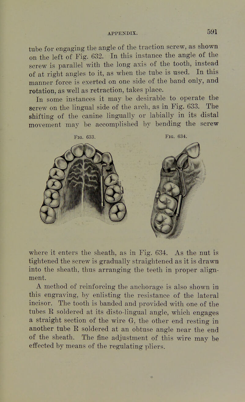 tube for engaging the angle of the traction screw, as shown on the left of Fig. 632. In this instance the angle of the screw is parallel with the long axis of the tooth, instead of at right angles to it, as when the tube is used. In this manner force is exerted on one side of the band only, and rotation, as well as retraction, takes place. In some instances it may be desirable to operate the screw on the lingual side of the arch, as in Fig. 633. The shifting of the canine lingually or labially in its distal movement may be accomplished by bending the screw where it enters the sheath, as in Fig. 634. As the nut is tightened the screw is gradually straightened as it is drawn into the sheath, thus arranging the teeth in proper align- ment. A method of reinforcing the anchorage is also shown in this engraving, by enlisting the resistance of the lateral incisor. The tooth is banded and provided with one of the tubes E soldered at its disto-lingual angle, which engages a straight section of the wire G-, the other end resting in another tube E soldered at an obtuse angle near the end of the sheath. The fine adjustment of this wire may be effected by means of the regulating pliers. Fig. 633. Fig. 634.