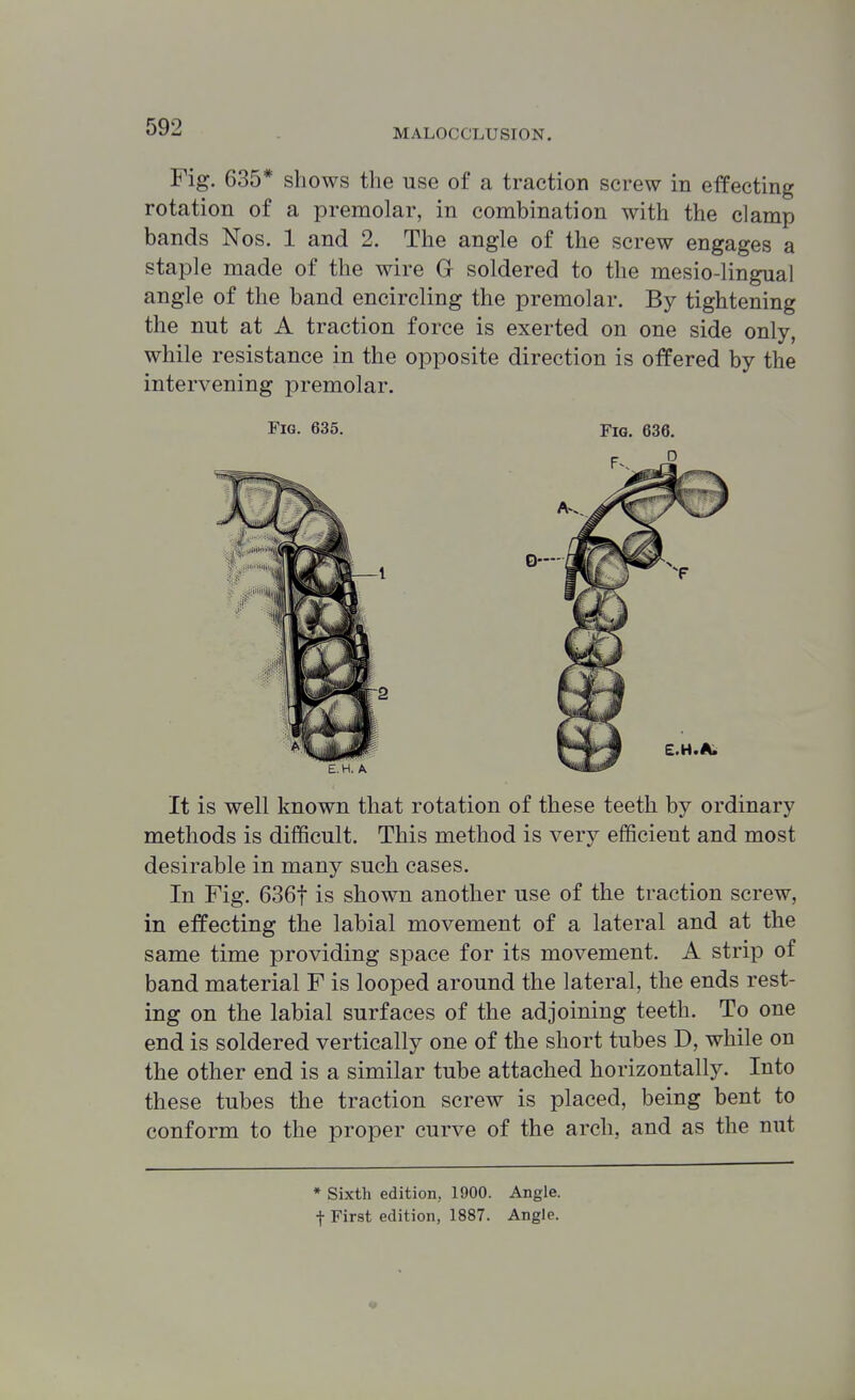 Fig. 635* shows the use of a traction screw in effecting rotation of a premolar, in combination with the clamp bands Nos. 1 and 2. The angle of the screw engages a staple made of the wire Gr soldered to the mesio-lingual angle of the band encircling the premolar. By tightening the nut at A traction force is exerted on one side only, while resistance in the opposite direction is offered by the intervening premolar. Fig. 635. Fig. 636. It is well known that rotation of these teeth by ordinary methods is difficult. This method is very efficient and most desirable in many such cases. In Fig. 636t is shown another use of the traction screw, in effecting the labial movement of a lateral and at the same time providing space for its movement. A strip of band material F is looped around the lateral, the ends rest- ing on the labial surfaces of the adjoining teeth. To one end is soldered vertically one of the short tubes D, while on the other end is a similar tube attached horizontally. Into these tubes the traction screw is placed, being bent to conform to the proper curve of the arch, and as the nut * Sixth edition, 1900. Angle,