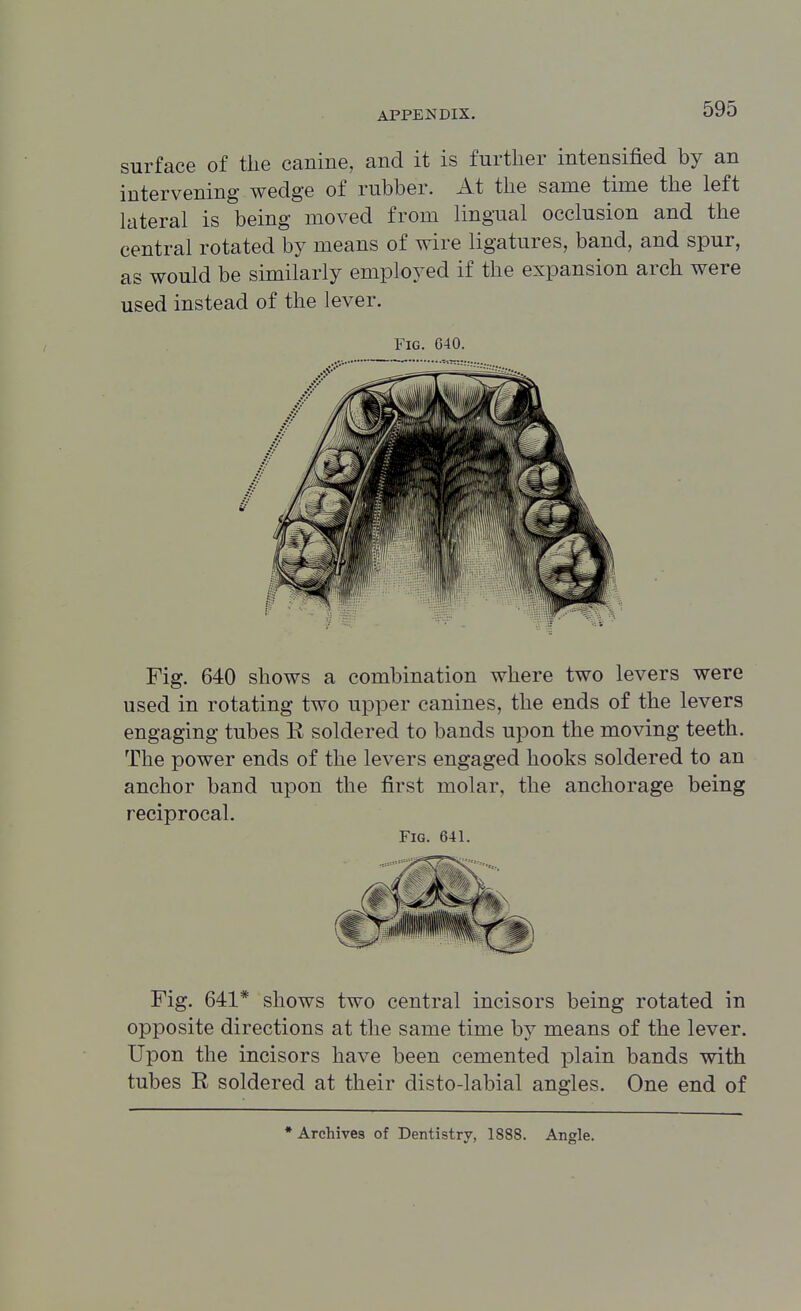 surface of the canine, and it is further intensified by an intervening wedge of rubber. At the same time the left lateral is being moved from lingTial occlusion and the central rotated by means of wire ligatures, band, and spur, as would be similarly employed if the expansion arch were used instead of the lever. Fig. C40. Fig. 640 shows a combination where two levers were used in rotating two upper canines, the ends of the levers engaging tubes R soldered to bands upon the moving teeth. The power ends of the levers engaged hooks soldered to an anchor band upon the first molar, the anchorage being reciprocal. Fig. 641. Fig. 641* shows two central incisors being rotated in opposite directions at the same time b}^ means of the lever. Upon the incisors have been cemented plain bands with tubes R soldered at their disto-labial angles. One end of * Archives of Dentistry, 1888. Angle.