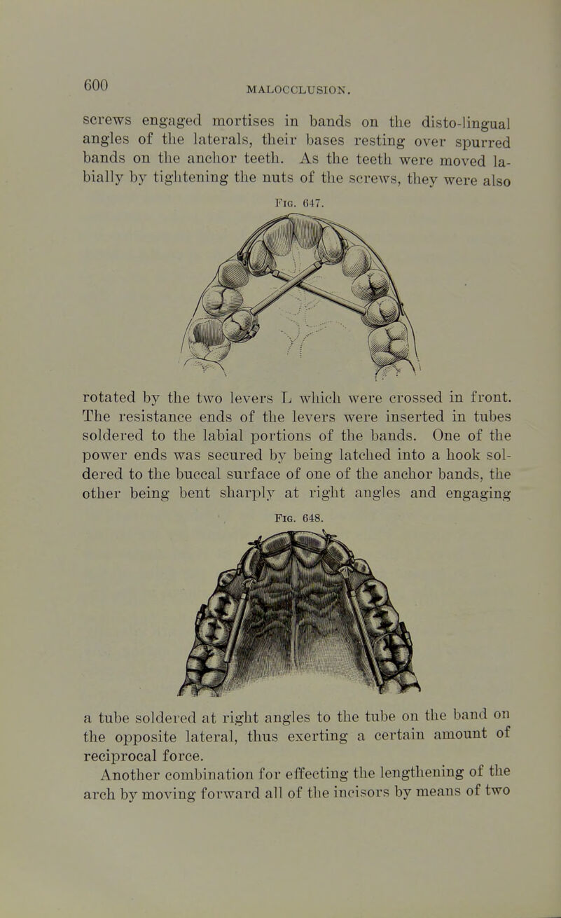 MALOCCLUSION. screws engaged mortises in bands on the disto-lingual angles of the laterals, their bases resting over spurred bands on the anchor teeth. As the teeth were moved la- bially by tightening the nuts of the screws, they were also Fig. 647. rotated by the two levers L which were crossed in front. The resistance ends of the levers were inserted in tubes soldered to the labial portions of the bands. One of the power ends was secured by being latched into a hook sol- dered to the buccal surface of one of the anchor bands, the other being bent sharply at right angles and engaging Fig. 648. a tube soldered at right angles to the tube on the band on the opposite lateral, thus exerting a certain amount of reciprocal force. Another combination for effecting the lengthening of the arch by moving forward all of the incisors by means of two