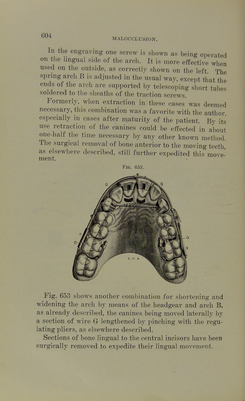 MALOCCLUSION. In the engraving one screw is shown as being operated on the Ungual side of the arcli. It is more effective when used on the outside, as correctly shown on the left The spring arch B is adjusted in the usual way, except that the ends of the arch are supported by telescoping short tubes soldered to the sheaths of the traction screws. Formerly, when extraction in these cases was deemed necessary, this combination was a favorite with the author especially in cases after maturity of the patient. By its use retraction of the canines could be effected in about one-half the time necessary by any other known method. The surgical removal of bone anterior to the moving teeth, as elsewhere described, still further expedited this move- ment. Fig. 653. Fig. 653 shows another combination for shortening and widening the arch by means of the headgear and arch B, as already described, the canines being moved laterally by a section of wire G- lengthened by pinching with the regu- lating pliers, as elsewhere described. Sections of bone lingual to the central incisors have been surgically removed to expedite their lingual movement.