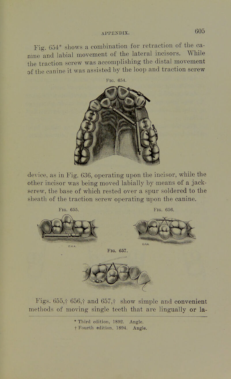 Fig. 654* shows a combination for retraction of the ca- nine and labial movement of the lateral incisors. While the traction screw was accomplishing the distal movement of the canine it was assisted by the loop and traction screw Fig. 654. device, as in Fig. 636, operating upon the incisor, while the other incisor was being moved labially by means of a jack- screw, the base of which rested over a spur soldered to the sheath of the traction screw operating upon the canine. Fig. 655. Fig. 656. Figs. 655,t 656,t and 657,t show simple and convenient methods of moving single teeth that are lingually or la- * Third edition, 1892. Angle,