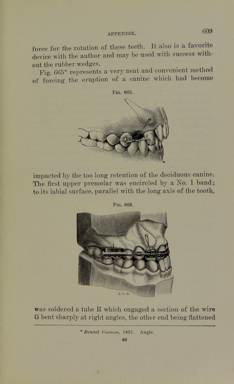 force for the rotation of these teeth. It also is a favorite device with the author and may be used with success with- out the rubber wedges. Fig. 665* represents a very neat and convenient method of forcing the eruption of a canine which had become Fig. 665. impacted by the too long retention of the deciduous canine. The first upper premolar was encircled by a No. 1 band; to its labial surface, parallel with the long axis of the tooth, Fig. 666. was soldered a tube R which engaged a section of the wire G bent sharply at right angles, the other end being flattened * Dental Cosmos, 1891. Angle. 40