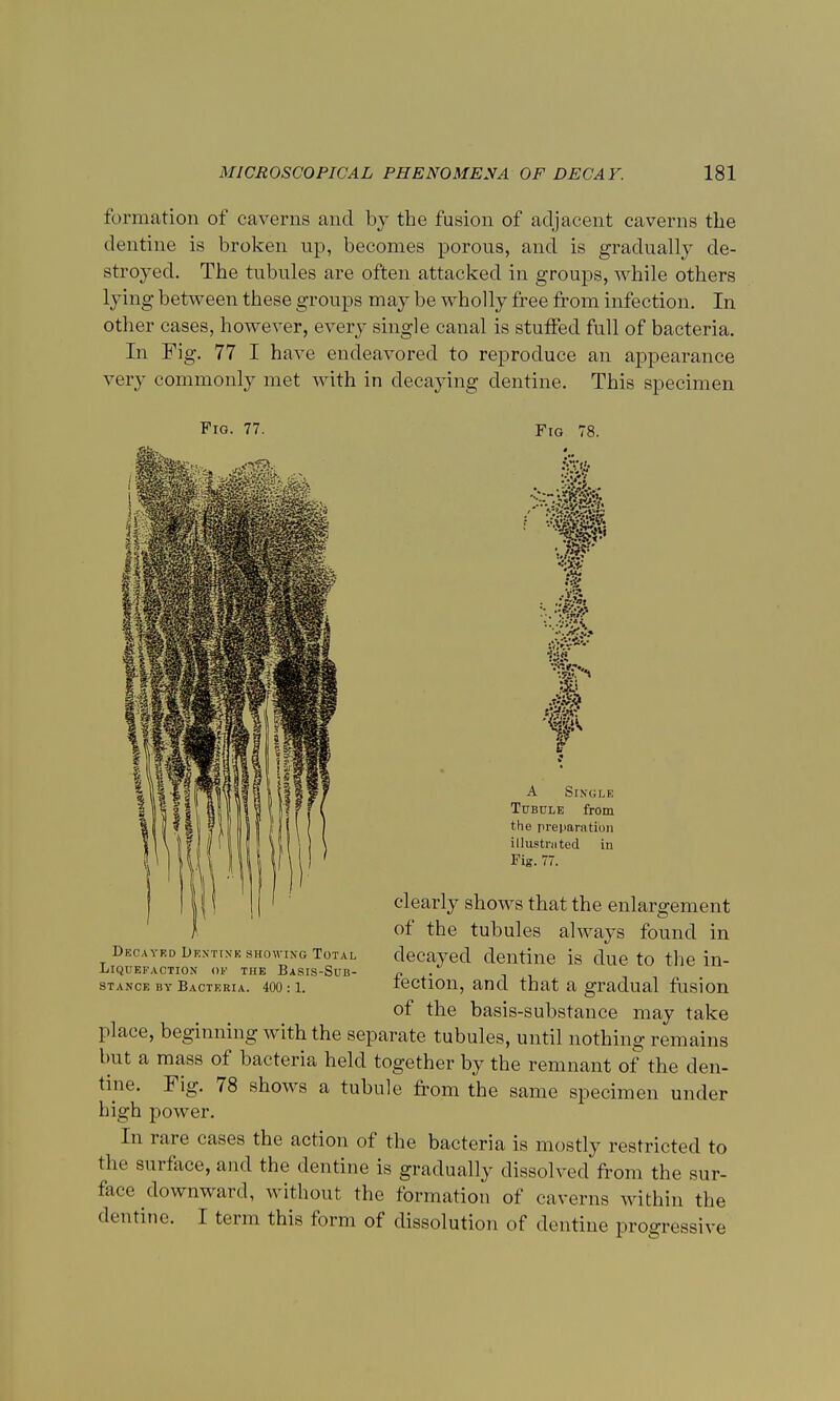 formation of caverns and by the fusion of adjacent caverns the dentine is broken up, becomes porous, and is gradually de- stroyed. The tubules are often attacked in groups, while others lying between these groups may be wholly free from infection. In other cases, however, every single canal is stuffed full of bacteria. In Fig. 77 I have endeavored to reproduce an appearance very commonly met with in decaying dentine. This specimen Fro. 77. Fig 78. ■■/■''is T A Single Tubule from the preparation illustrated in Fig. 77. Decayed Dentine showing Total Liquefaction of the Basis-Sub- stance by Bacteria. 400 :1. clearly shows that the enlargement of the tubules always found in decayed dentine is due to the in- fection, and that a gradual fusion of the basis-substance may take place, beginning with the separate tubules, until nothing remains but a mass of bacteria held together by the remnant of the den- tine. Fig. 78 shows a tubule from the same specimen under high power. In rare cases the action of the bacteria is mostly restricted to the surface, and the dentine is gradually dissolved from the sur- face downward, without the formation of caverns within the dentine. I term this form of dissolution of dentine progressive