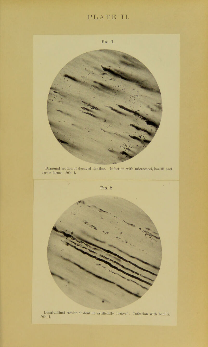 PLATE 11. Pig. 1. Diagonal section of decayed dentine. Infection with micrococci, bacilli and screw-forms. 500 : 1. Fm. 2 Longitudinal seotion of dentil .rtifioially deoayed. [nfootion with bacilli 500 : 1.