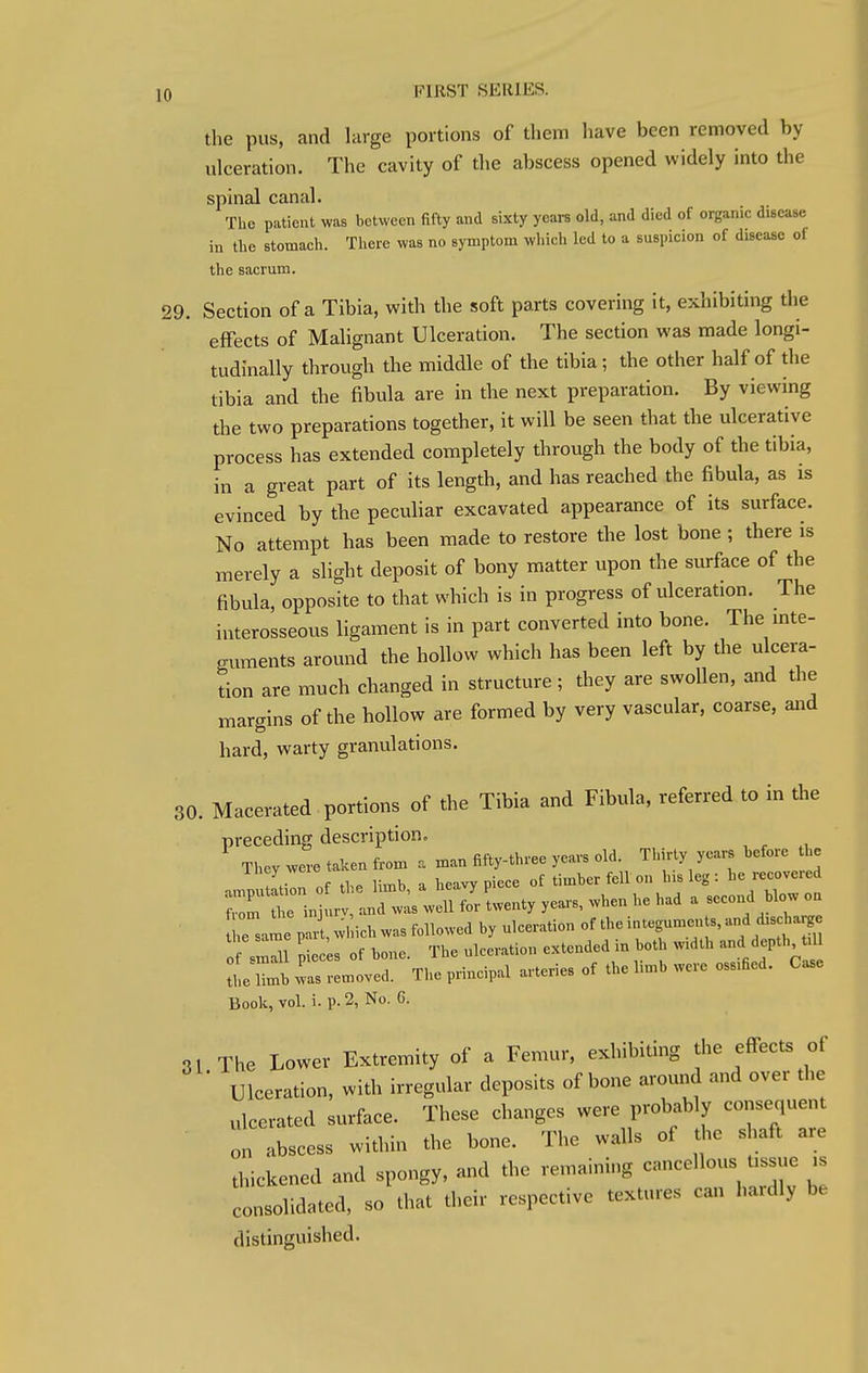 the pus, and large portions of them have been removed by ulceration. The cavity of the abscess opened widely into the spinal canal. The patient was between fifty and sixty years old, and died of organic disease in the stomach. There was no symptom which led to a suspicion of disease of the sacrum. 29. Section of a Tibia, with the soft parts covering it, exhibiting the effects of Malignant Ulceration. The section was made longi- tudinally through the middle of the tibia; the other half of the tibia and the fibula are in the next preparation. By viewing the two preparations together, it will be seen that the ulcerative process has extended completely through the body of the tibia, in a great part of its length, and has reached the fibula, as is evinced by the peculiar excavated appearance of its surface. No attempt has been made to restore the lost bone; there is merely a slight deposit of bony matter upon the surface of the fibula, opposite to that which is in progress of ulceration. The interosseous ligament is in part converted into bone. The inte- guments around the hollow which has been left by the ulcera- tion are much changed in structure ; they are swollen, and the margins of the hollow are formed by very vascular, coarse, and hard, warty granulations. 30. Macerated portions of the Tibia and Fibula, referred to in the preceding description. They were taken from a man fifty-three years old. Thirty years before the ihey weie t timber fell on his leg : he recovered tie same paiw ich was followed by ulceration of the integuments, and discharge f 8mTll Pieces of bone. The ulceration extended in both width and depth ,1 the limb was removed. The principal arteries of the Huib were ossified. Case Book, vol. i. p. 2, No. G. 31 The Lower Extremity of a Femur, exhibiting the effects of ' Ulceration, with irregular deposits of bone around and over the ulcerated surface. These changes were probably consequent on abscess within the bone. The walls of the shaft are thickened and spongy, and the remaining cancellous tassue is consolidated, so that their respective textures can hardly be distinguished.