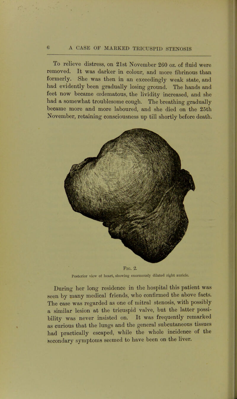 To relieve distress, on 21st November 260 oz. of fluid were removed. It was darker in colour, and more fibrinous than formerly. She was then in an exceedingly weak state, and had evidently been gradually losing ground. The hands and feet now became oedematous, the lividity increased, and she had a somewhat troublesome cough. The breathing gradually became more and more laboured, and she died on the 25th November, retaining consciousness up till shortly before death. Fig. 2. Posterior view of heart, showing enormously dilated right auricle. During her long residence in the hospital this patient was seen by many medical friends, who confirmed the above facts. The case was regarded as one of mitral stenosis, with possibly a similar lesion at the tricuspid valve, but the latter possi- bility was never insisted on. It was frequently remarked as curious that the lungs and the general subcutaneous tissues had practically escaped, while the whole incidence of the secondary symptoms seemed to have been on the liver,