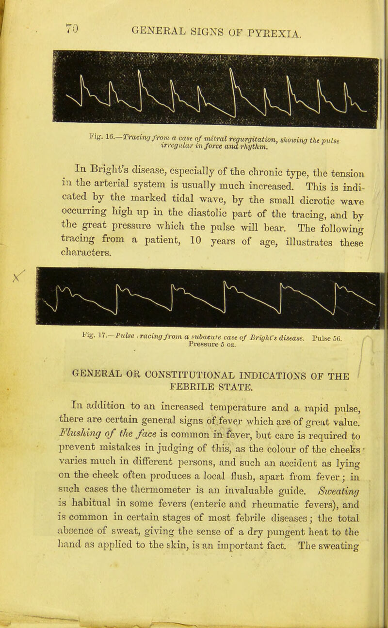 I'lg. lO.—Tracin'j JroM a case of mitral regurgitation, skowi/ig the pulse ■irregular in force and rhythm. In Bright's disease, especially of the chronic type, the tension in the arterial system is usually much increased. This is indi- cated by the marked tidal wave, by the small dicrotic wave occurring high up in the diastolic part of the tracing, and by the great pressure which the pulse will bear. The following tracing from a patient, 10 years of age, illustrates these characters. 1-1^. n.—Pulse . racing from a ntbaeuie faye of Bright's disease. Pulse 06 Pi-essiire 5 oz. Pi-essiire 5 oz. GENERAL OR CONSTITUTIONAL INDICATIONS OF THE FEBEILE STATE. In addition to an increased temperature and a rapid pidse, there are certain general signs of fever which are of great value. FlusJdng of the face is common in fever, but care is required to prevent mistakes in judging of this, as the colour of the cheeks varies much in different persons, and such an accident as lying on the cheek often produces a local flush, apart from fever; in such cases the thermometer is an invaluable guide. Sweating is habitual in some fevers (enteric and rheumatic fevers), and is common in certain stages of most febrile diseases; the total absence of sweat, giving the sense of a dry pungent heat to the Iiand as applied to the skin, is an important fact. The sweating