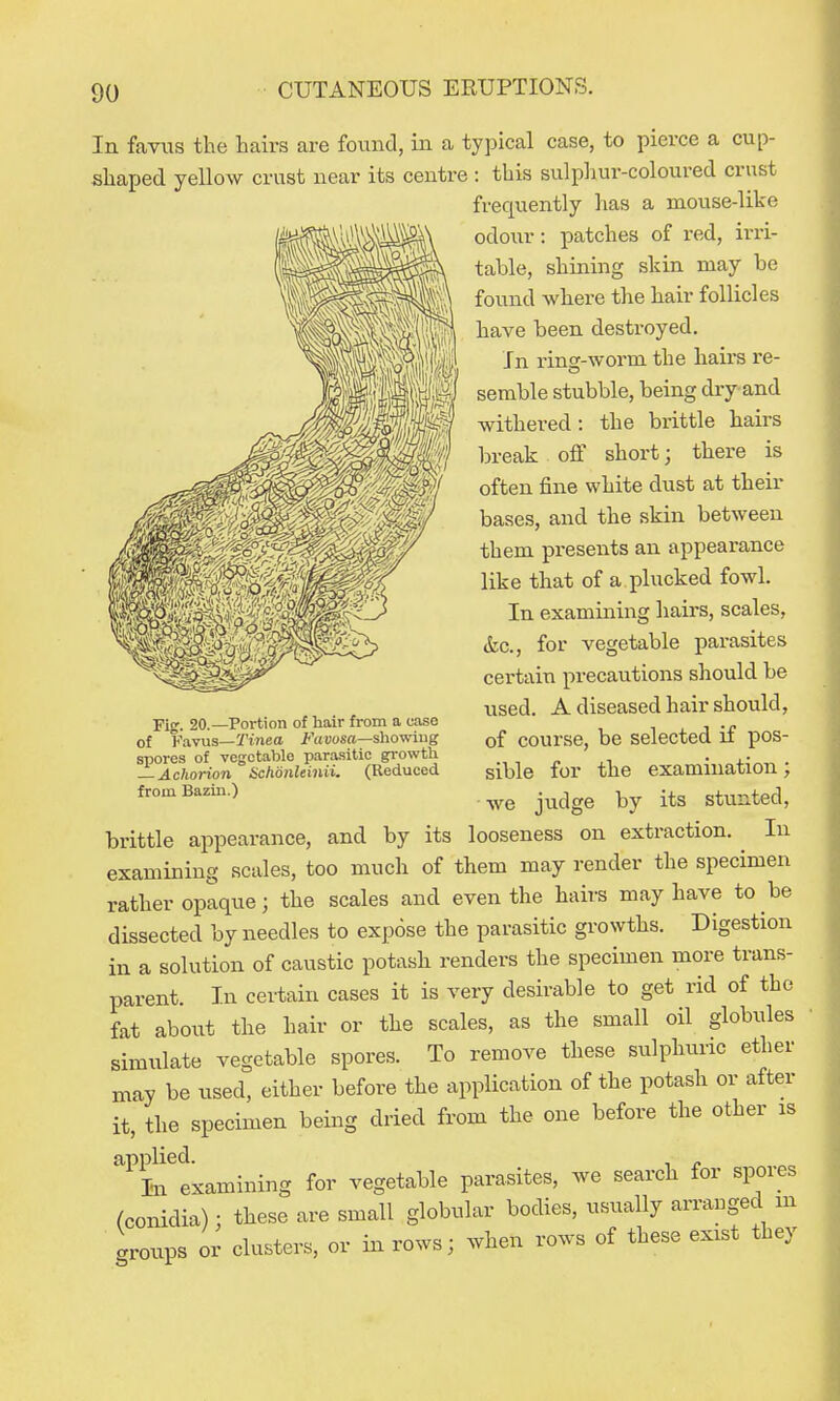 In faviis the hairs are found, in a typical case, to pierce a cup- shaped yellow crust near its centre : this sulphur-coloured crust frequently has a mouse-like odour: patches of red, irri- table, shining skin may be found where the hair follicles have been destroyed. In ring-worm the hairs re- semble stubble, being dry and withered: the brittle hairs break off short; there is often fine white dust at their bases, and the skin between them presents an appearance like that of a plucked fowl. In examining hairs, scales, &c., for vegetable parasites certain precautions should be used. A diseased hair should, of course, be selected if pos- sible for the examination; we judge by its stunted, brittle appearance, and by its looseness on extraction. ^ In examining scales, too much of them may render the specimen rather opaque; the scales and even the hairs may have to be dissected by needles to expose the parasitic growths. Digestion in a solution of caustic potash renders the specimen more trans- parent. In certain cases it is very desirable to get rid of the fat about the hair or the scales, as the small oil globules simulate vegetable spores. To remove these sulphuric ether may be used, either before the application of the potash or after it, the specimen being dried from the one before the other is ^^examining for vegetable parasites, we search for spores (conidia) : these are small globular bodies, usually arrauged m .roups or clusters, or in rows; when rows of these exist they Fig. 20.—Portion of hair from a case of Favus—Tinea i<V(Vosa—sliowiug spores of vegetable parasitic growth — Achorion Schdnleinii. (Reduced from Bazin.)