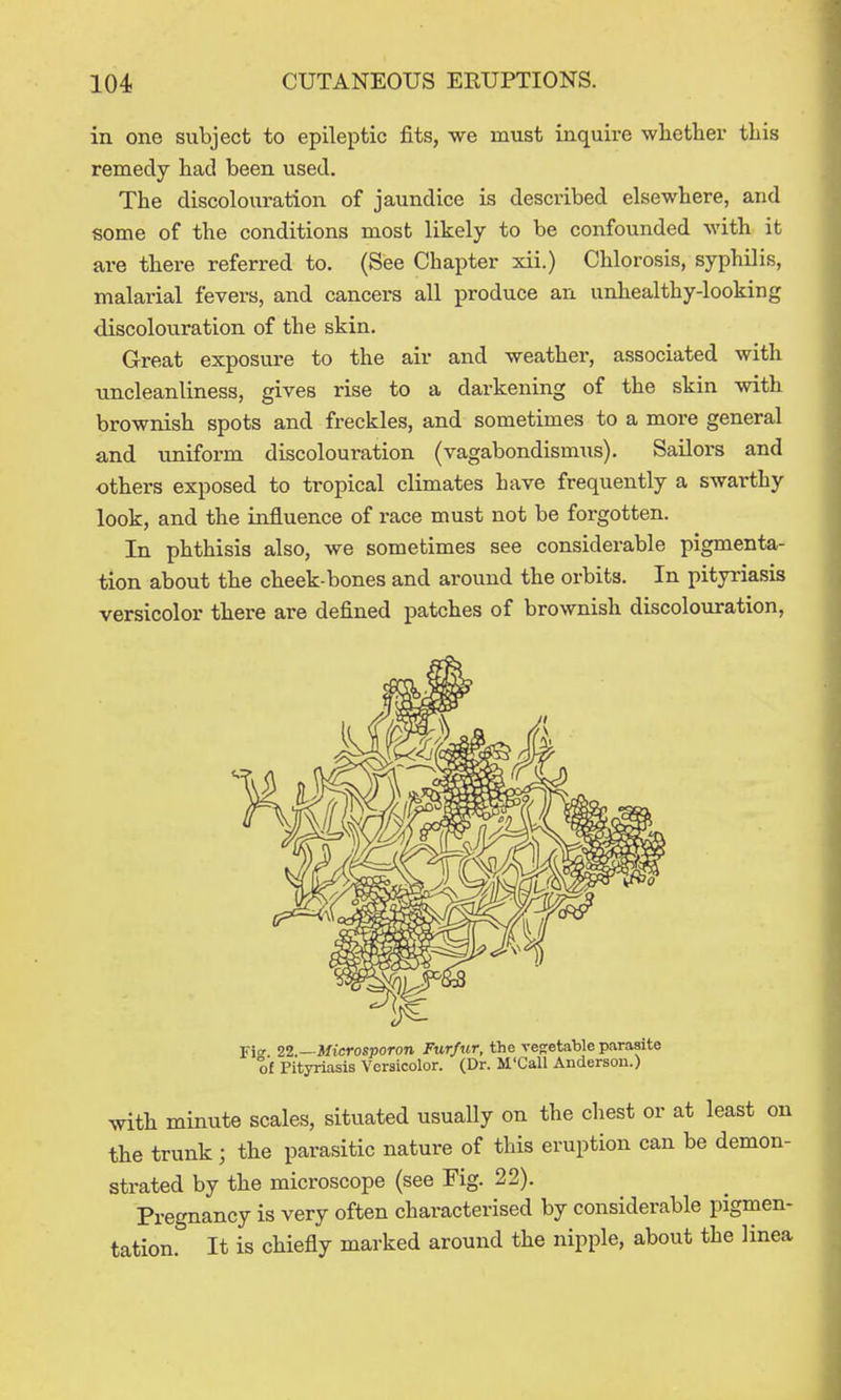 in one subject to epileptic fits, we must inquire whether this remedy had been used. The discolouration of jaundice is described elsewhere, and some of the conditions most likely to be confounded with it are there referred to. (See Chapter xii.) Chlorosis, syphilis, malarial fevers, and cancers all produce an unhealthy-looking discolouration of the skin. Great exposure to the air and weather, associated with tmcleanliness, gives rise to a darkening of the skin with brownish spots and freckles, and sometimes to a more general and uniform discolouration (vagabondismus). Sailors and others exposed to tropical climates have frequently a swarthy look, and the influence of race must not be forgotten. In phthisis also, we sometimes see considerable pigmenta- tion about the cheek-bones and around the orbits. In pityriasis versicolor there are defined patches of brownish discolouration, JW Z2.—Microsporon Furfur, the vegetable parasite of Pityriasis Versicolor. (Dr. M'Call Anderson.) with minute scales, situated usually on the cliest or at least on the trunk; the parasitic nature of this eruption can be demon- strated by the microscope (see Fig. 22). Pregnancy is very often characterised by considerable pigmen- tation. It is chiefly marked around the nipple, about the linea