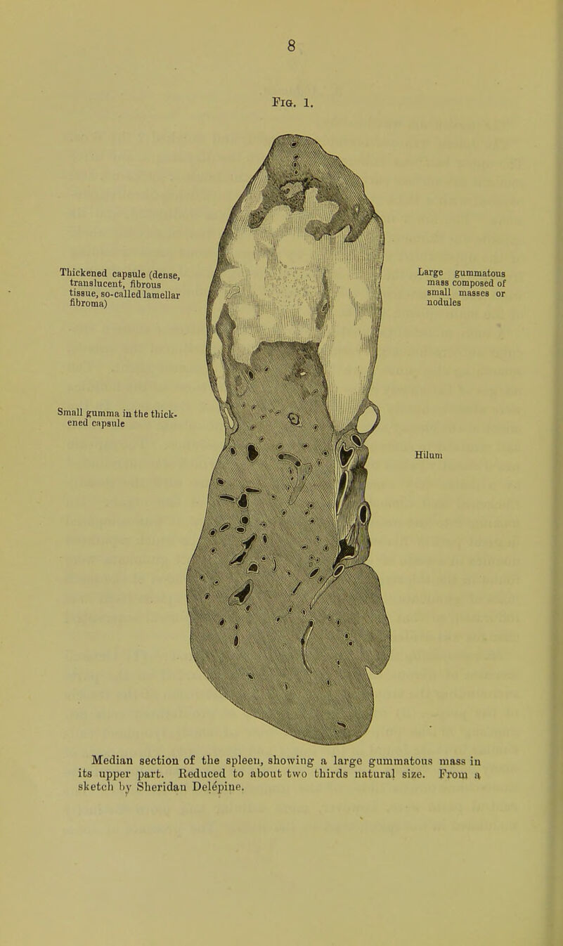 Fig. 1. Thickened capsule (dense, translucent, fibrous tissue, so-cnlled lamellar fibroma) Small gumma in the thick- ened cnpsule Large gummatous mass composed of small masses or nodules Hiluni Median section of the spleen, showing a large gummatous mass iu its upper part. Kcduced to about two thirds natural size. From a sketcli 1)^- Sheridan Delepiue.