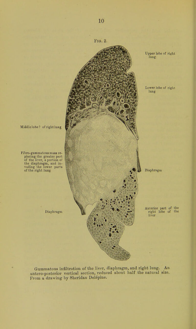 Fig. 2. Gummatous infiltration of the livor, diaphragm, and right lung. An antero-posterior vertical section, reduced about half the natural size. From a drawing by Sheridan Delepine.