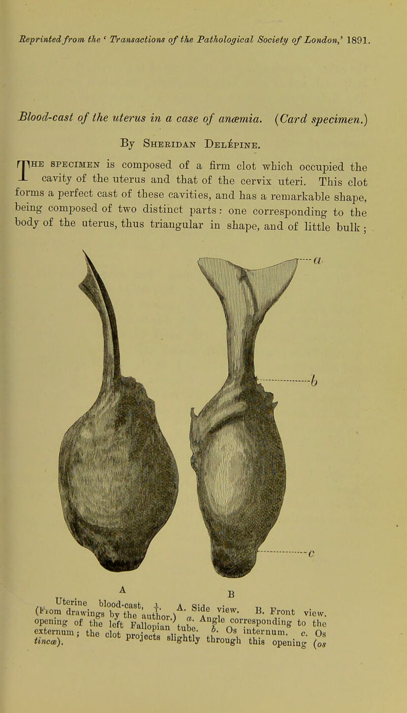 Reprinted from the ' Transactions of the Pathological Society of London,' 1891. Blood-cast of the uterus in a case of anamia. {Card specimen.) By Sheridan Delepine. The specimen is composed of a firm clot which occupied the cavity of the uterus and that of the cervix uteri. This clot forms a perfect cast of these cavities, and has a remarkable shape, being composed of two distinct parts: one corresponding to the body of the uterus, thus triangular in shape, and of little bulk ■ —- a A B Uterine blood-casf i a q-j (K»om drawings by fho author ^ ? V™' B Ppont view- opening of t£ leV FaiCa^tuS Anfta «»™«Ponding to the externum; the clot nmi T r u ' J' 0s sternum, c. Os tine*). Cl0t pr°3ects »l>ghtty through this opening (os