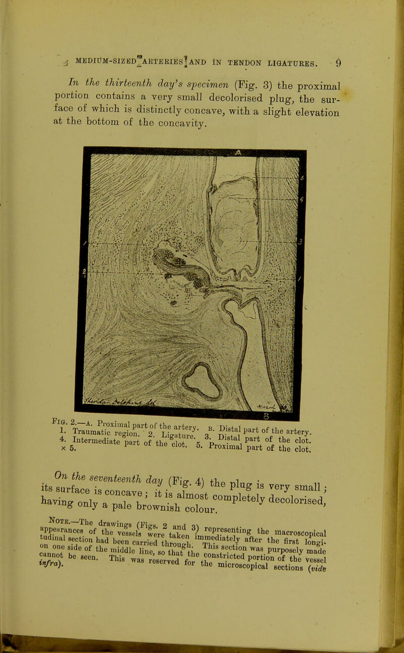 In the thirteenth clay's specimen (Fig. 3) the proximal portion contains a very small decolorised plug, the sur- face of which is distinctly concave, with a slight elevation at the bottom of the concavity. 4- Intermediate part ohheVoT\ % Dl.stal1 Parfc «* the clot, x 5. P tne clot 5' Proximal part of the clot. Note.—The drawings (Fies. 2 nnri q\ appearances of the vessels Tere tS?n ?«™P^ting the ^roMopical