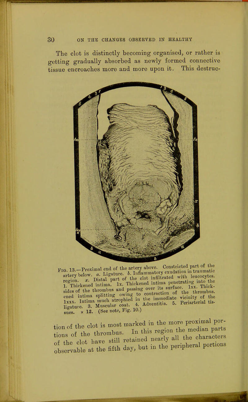 The clot is distinctly becoming organised, or rather is getting gradually absorbed as newly formed connective tissue encroaches more and more upon it. This destruc- „rt„, below. ^^J-JfZ^L^ ««*. le».«»jt,t lieataie. 3. Muscular coat. 4 Adient.tia. sues. « 12- (See note, Fig. 10.) f «,p Hot is roost marked in the more proximal por- tion cithe, ok* s roos t]je med.an parts oftle clo^ave stiH retained nearly all the characters Iservable at the fifth day, but in the penphera. port.ons