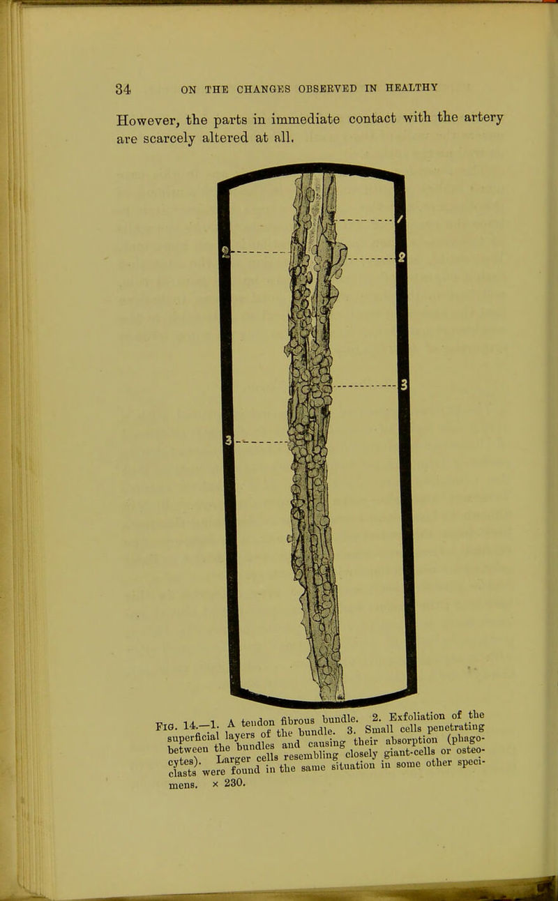_ - . i A tendon fibrous bundle. 2. Exfoliation of the FIG. 14.-1. A teud°° rLndle. 3. Small cells penetrating superficial layers ot the bu^len . e^ £ (pbag0. be;PTn Larger c s r semblin/closely giant-cells or osteo- Ists^ertTund in the sa.ne situation in some other spec mens, x 230.