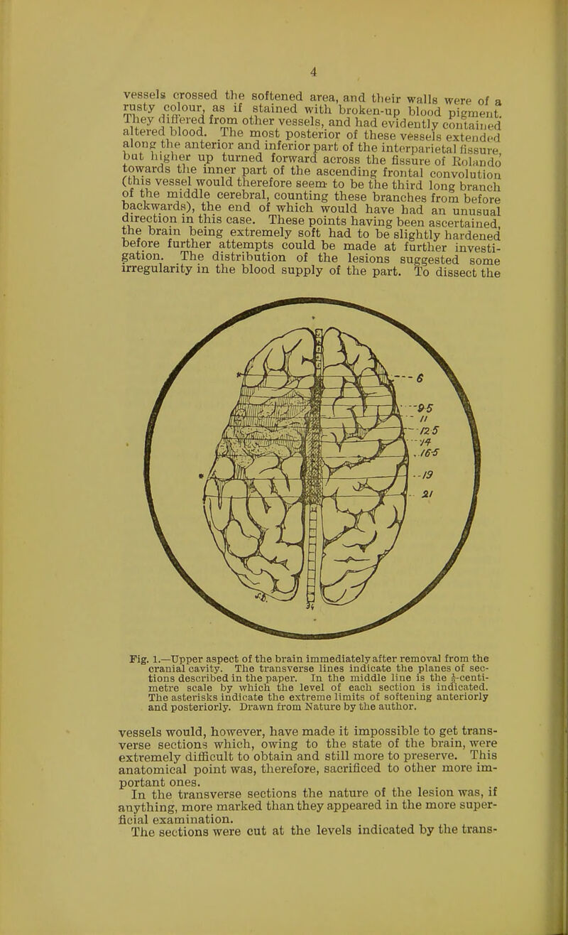 vessels crossed the softened area, and tlieir walls were of a rusty colour as if stained with broken-up blood pigment. They Jbflered from other vessels, and had evidently contained altered blood. The most posterior of these vessels extended along the anterior and inferior part of the interparietal fissure bat higher up turned forward across the fissure of Rolando towards the inner part of the ascending frontal convolution (this vessel would therefore seem to be the third long branch of the middle cerebral, counting these branches from before backwards), the end of which would have had an unusual direction m this case. These points having been ascertained, the brain being extremely soft had to be slightly hardened before further attempts could be made at further investi- gation. The distribution of the lesions suggested some irregularity in the blood supply of the part. To dissect the Fig. 1.—Upper aspect of the brain immediately after removal from the cranial cavity. The transverse lines indicate the planes of sec- tions described in the paper. In the middle line is the ^-centi- metre scale by which the level of each section is indicated. The asterisks indicate the extreme limits of softening anteriorly and posteriorly. Drawn from Nature by the author. vessels would, however, have made it impossible to get trans- verse sections which, owing to the state of the brain, were extremely difficult to obtain and still more to preserve. This anatomical point was, therefore, sacrificed to other more im- portant ones. In the transverse sections the nature of the lesion was, if anything, more marked than they appeared in the more super- ficial examination. The sections were cut at the levels indicated by the trans-