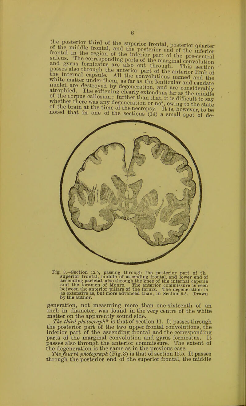 the posterior third of the superior frontal nnstm.;™. * of the middle frontal, and th^posterio^^S°o the^Slor frontal in the region of the inferior part of the we central sulcus. Thet corresponding parts of the marginal^convolution and gyrus fornicatus are also cut through This sec on~ passes also through the anterior part of the anterior limb of the^internal capsule All the convolutions named and the white matter under them, as far as the lenticular and caudate atrophieT Sfi ^ ^T^f3 are nsidSS ly atrophied. The softening clearly extends as far as the middle whe^pAC'fl0SUmJ, further}>an that> n is difficult to say whether there was any degeneration or not, owing to the state noted' ?wn-at the Mr+1?f the ?-ecr°P^ ft is> ^wever6 £ he noted that in one of the sections (14) a small spot of de- Fig. 3.—Section 12.5, passing through the posterior part of th superior frontal, middle of asoending frontal, and lower end of ascending parietal, also through the knee of the internal capsule and the foramen of Monro. The anterior commissure is seen between the anterior pillars of the fornix. The degeneration is as extensive as, but more advanced than, in Section 9.5. Drawn by the author. generation, not measuring more than one-sixteenth of an inch in diameter, was found in the very centre of the white matter on the apparently sound side. The third photograph* is that of section 11. It passes through the posterior part of the two upper frontal convolutions, the inferior part of the ascending frontal and the corresponding parts of the marginal convolution and gyrus fornicatus. It passes also through the anterior commissure. The extent of the degeneration is the same as in the previous case. The fourth photograph (Fig. 3) is that of section 12.5. It passes through the posterior end of the superior frontal, the middle