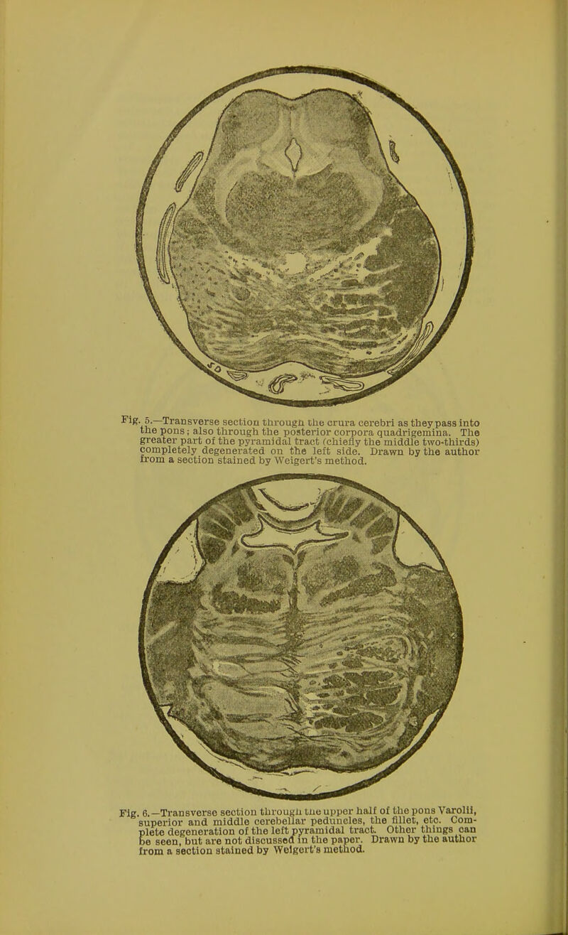 Fig- 5.—Transverse section througn the crura cerebri as they pass into the pons; also through the posterior corpora quadrigemina. The greater part of the pyramidal tract (chiefly the middle two-thirds) completely degenerated on the left side. Drawn by the author from a section stained by Weigert's method. Fig. 6.—Transverse section through tne upper half of the pons Varolii, superior and middle cerebellar peduncles, the fillet, etc. Com- plete degeneration of the left pyramidal tract. Other things oan be seen, but are not discussed in the paper. Drawn by the author from a section stained by Weigert's method.
