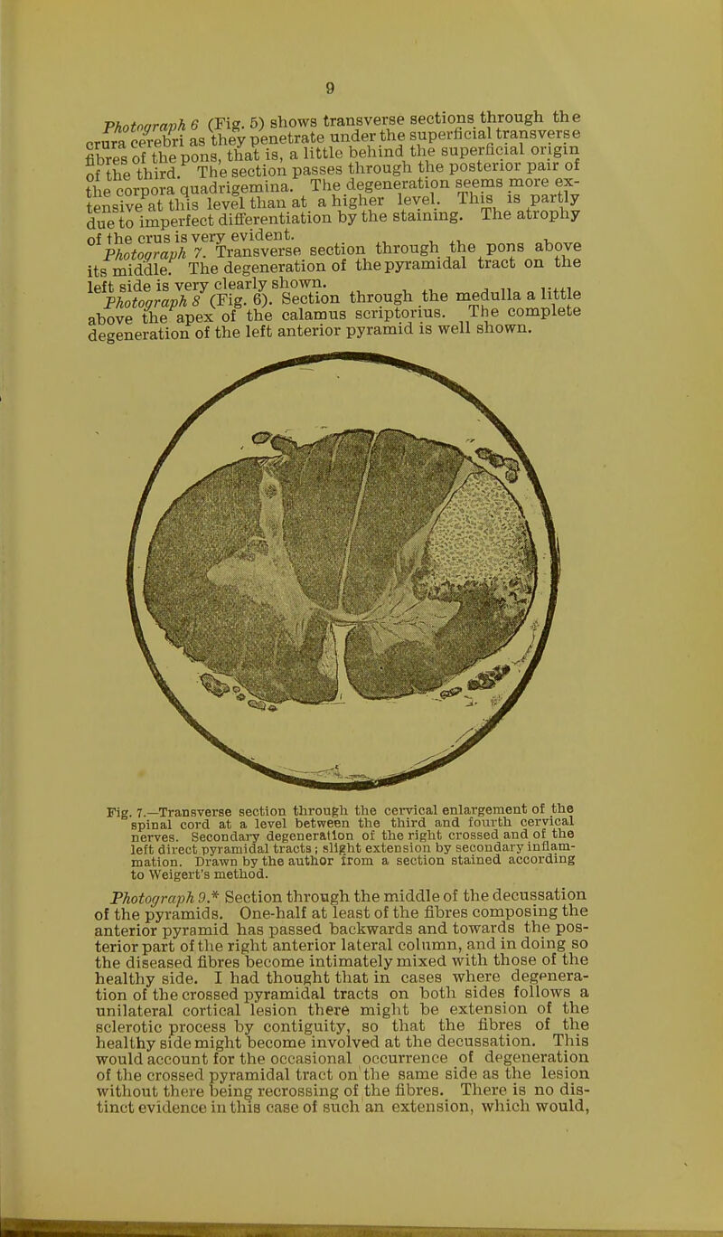 g Phntoaranh 6 (Fig. 5) shows transverse sections through the cru?a SX as they penetrate under the superficial transverse fibres of the pons, that is, a little behind the superficial origin of the third. The section passes through the posterior pair of the corpora quadrigemina. The degeneration seems more ex- tensive at this level than at a higher level. This is partly due to imperfect differentiation by the staining. The atrophy of the crus is very evident. Photograph 7. Transverse section through the pons above its middlef The degeneration of the pyramidal tract on the left side is very clearly shown. Photograph 8 (Fig. 6). Section through the medulla a little above the apex of the calamus scriptonus. The complete degeneration of the left anterior pyramid is well shown. Fig. 7.—Transverse section through the cervical enlargement of the spinal cord at a level between the third and fourth cervical nerves. Secondary degeneration of the right crossed and of the left direct pyramidal tracts; slight extension by secondary inflam- mation. Drawn by the author irom a section stained according to Weigert's method. Photograph 9* Section through the middle of the decussation of the pyramids. One-half at least of the fibres composing the anterior pyramid has passed backwards and towards the pos- terior part of the right anterior lateral column, and in doing so the diseased fibres become intimately mixed with those of the healthy side. I had thought that in cases where degenera- tion of the crossed pyramidal tracts on both sides follows a unilateral cortical lesion there might be extension of the sclerotic process by contiguity, so that the fibres of the healthy side might become involved at the decussation. This would account for the occasional occurrence of degeneration of the crossed pyramidal tract on'the same side as the lesion without there being recrosBing of the fibres. There is no dis- tinct evidence in this case of such an extension, which would,