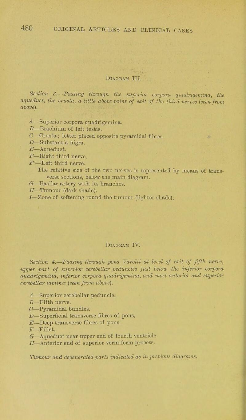 DiAGEAM III. Section ,3--Passing through the sujjerior corpora qitadrigemina, the aqueduct, the crusta, a little above point of exit of the third nerves {seen from above). A.—Superior corpora quadrigemina. B—Brachium of left testis. C—Crusta; letter placed opposite pyramidal fibres. D—Substantia nigra. E—Aqueduct. F—Eight third nerve. F'—Left third nerve. The relative size of the two nerves is represented by means of trans- verse sections, below the main diagram. G—Basilar artery with its branches. H—Tumour (dark shade). I—Zone of softening round the tumour (lighter shade). DiAGBAM IV. Section 4.—Passing through pons Varolii at level of exit of fifth nerve, upper part of superior cerebellar pedimclcs just below the inferior coipora guadrigemina, inferior corpora guadrigemina, and most anterior and' sv,perior cerebellar lamina: (seen from above). A—Superior cerebellar peduncle. B—Fifth nerve. C—Pyramidal bundles. D—Superficial transverse fibres of pons. E—Deep transverse fibres of pons. J'—FiUet. G—Aqueduct near upper end of fourth ventricle. B—Anterior end of superior vermiform process. Tumour and degenerated parts indicated as in previous diagrams.