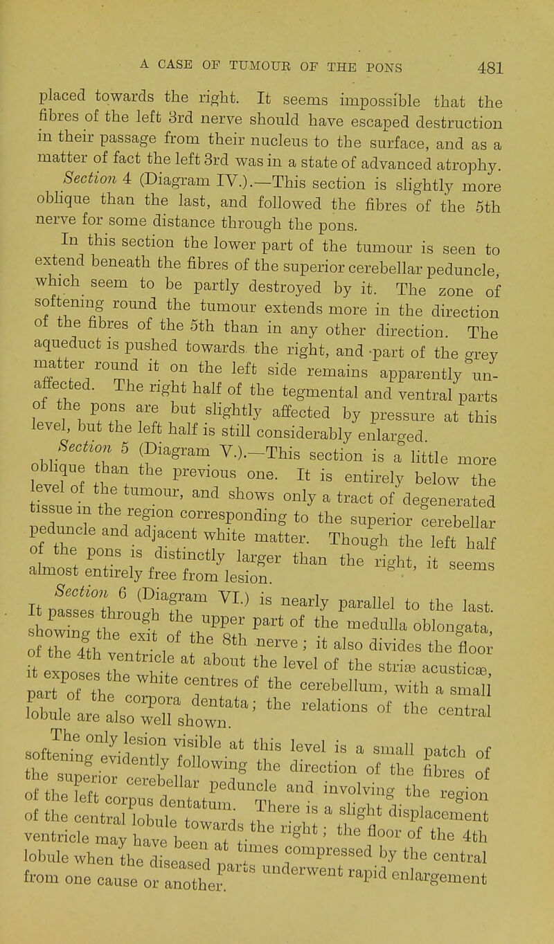 placed towards the right. It seems impossible that the fibres of the left 8rd nerve should have escaped destruction in their passage from their nucleus to the surface, and as a matter of fact the left 3rd was in a state of advanced atrophy. Section 4 (Diagram IV.).—This section is slightly more obhque than the last, and followed the fibres of the 5th nerve for some distance through the pons. In this section the lower part of the tumour is seen to extend beneath the fibres of the superior cerebellar peduncle which seem to be partly destroyed by it. The zone of softemng round the tumour extends more in the direction of the fibres of the 5th than in any other direction The aqueduct is pushed towards the right, and -part of the grey matter round it on the left side remains apparently un- affected. The right half of the tegmental and ventral parts Z 1 /.Tu ^^ P^^^^^^^e at this level, but the left half is still considerably enlarged nhr r ^ V.).-This section is a little more obhqne than the previous one. It is entirely below the sstt tt ~ only a tract of degenerated tissue m the region corresponding to the superior Cerebellar ped.mcle and adjacent white matter. Though the left half 0 the pons IS distinctly larger than the right, it seems almost entirely free from lesion • Itpts^Ihrou^hT ^^-^  ^^^^^ *° of the II . T 1 ''^''^ ' ^1^0 ^^i^icles the floor of the 4th ventricle at about the level of the striae acustic^ par^'oTTh ' ^^'^^^ --^^11--. with a sman softLtgtittrvt?o'-'' 'r'' ^^'^'^ thp ..Z .^v^clent y following the direction of the fibres of of the central toLle 11'  displacement ventricle ™ay U^lVelnTtt ' °' lobule when Ihe dLaTea nt r™^''''''' ''^ -=^-1 from one cause or anothev enlargement