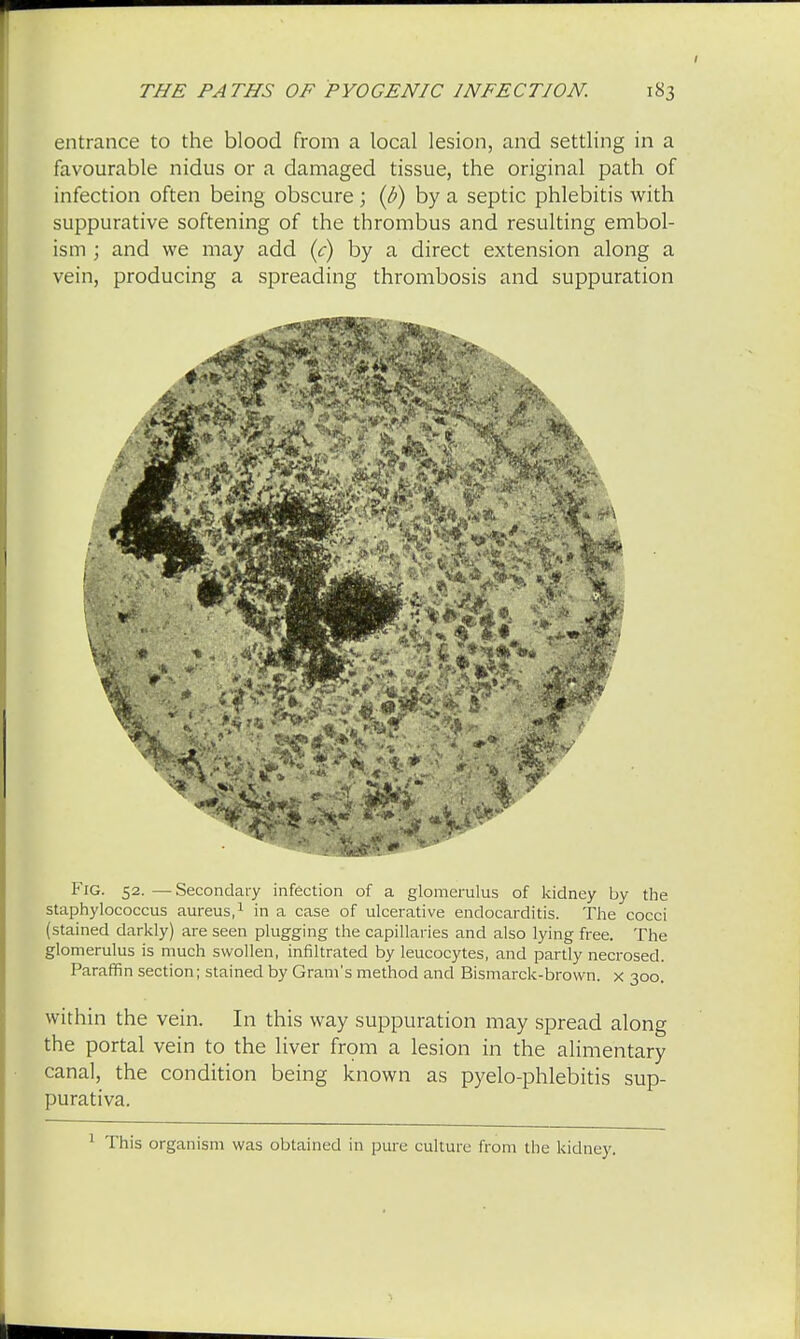 entrance to the blood from a local lesion, and settling in a favourable nidus or a damaged tissue, the original path of infection often being obscure; (b) by a septic phlebitis with suppurative softening of the thrombus and resulting embol- ism ; and we may add (c) by a direct extension along a vein, producing a spreading thrombosis and suppuration Fig. 52. — Secondary infection of a glomerulus of kidney by the staphylococcus aureus,1 in a case of ulcerative endocarditis. The cocci (stained darkly) are seen plugging the capillaries and also lying free. The glomerulus is much swollen, infiltrated by leucocytes, and partly necrosed. Paraffin section; stained by Gram's method and Bismarck-brown, x 300. within the vein. In this way suppuration may spread along the portal vein to the liver from a lesion in the alimentary canal, the condition being known as pyelo-phlebitis sup- purativa. 1 This organism was obtained in pure culture from the kidney.