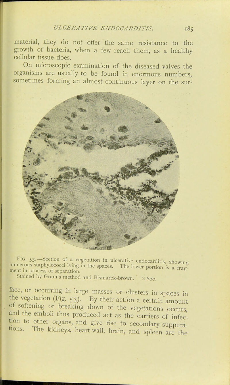 UL CERA Tl VE ENDOCARDITIS. material, they do not offer the same resistance to the growth of bacteria, when a few reach them, as a healthy cellular tissue does. On microscopic examination of the diseased valves the organisms are usually to be found in enormous numbers, sometimes forming an almost continuous layer on the sur- m £ Fig. 53.—Section of a vegetation in ulcerative endocarditis, showing numerous staphylococci lying in the spaces. The lower portion is a frar ment in process of separation. s Stained by Gram's method and Bismarck-brown. x 600. face, or occurring in large masses or clusters in spaces in the vegetation (Fig. 53). By their action a certain amount of softening or breaking down of the vegetations occurs and the emboli thus produced act as the carriers of infec- tion to other organs, and give rise to secondary suppura- tions. The kidneys, heart-wall, brain, and spleen are the