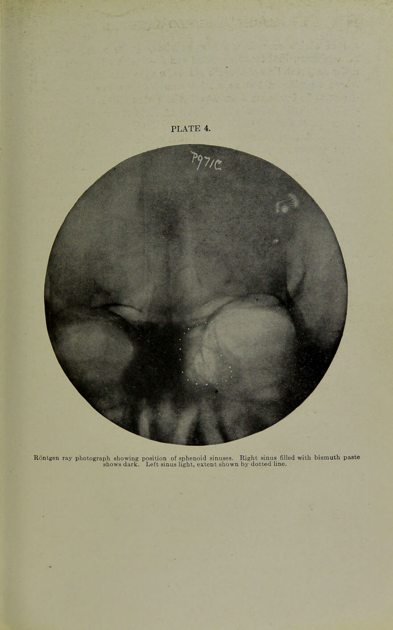 Rbntgen ray photograph showing position of sphenoid sinuses. Right sinus filled with bismuth paste shows dark. Left sinus light, extent shown by dotted line.