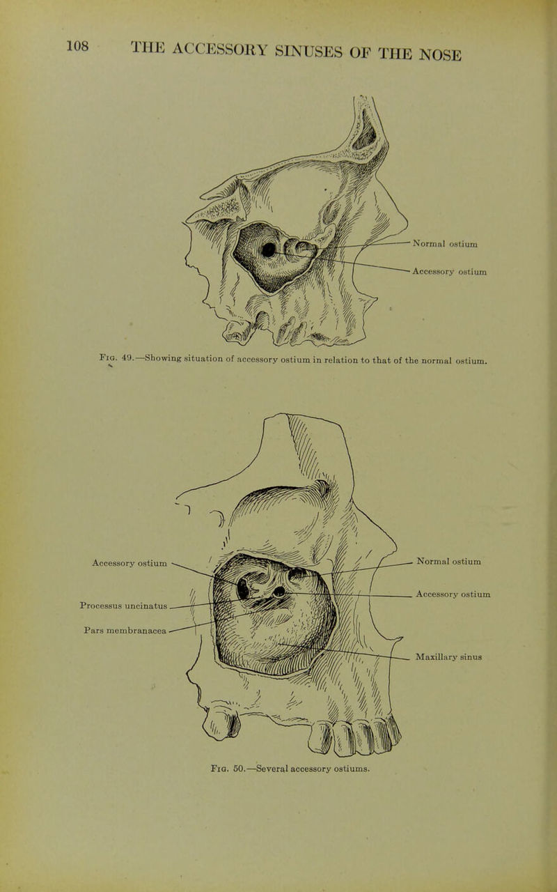 Accessory ostium Processus uncinatus Pars membranacea Normal ostium Accessory ostium Maxillarj' sinus Fig. 50.—Several accessory ostiums.