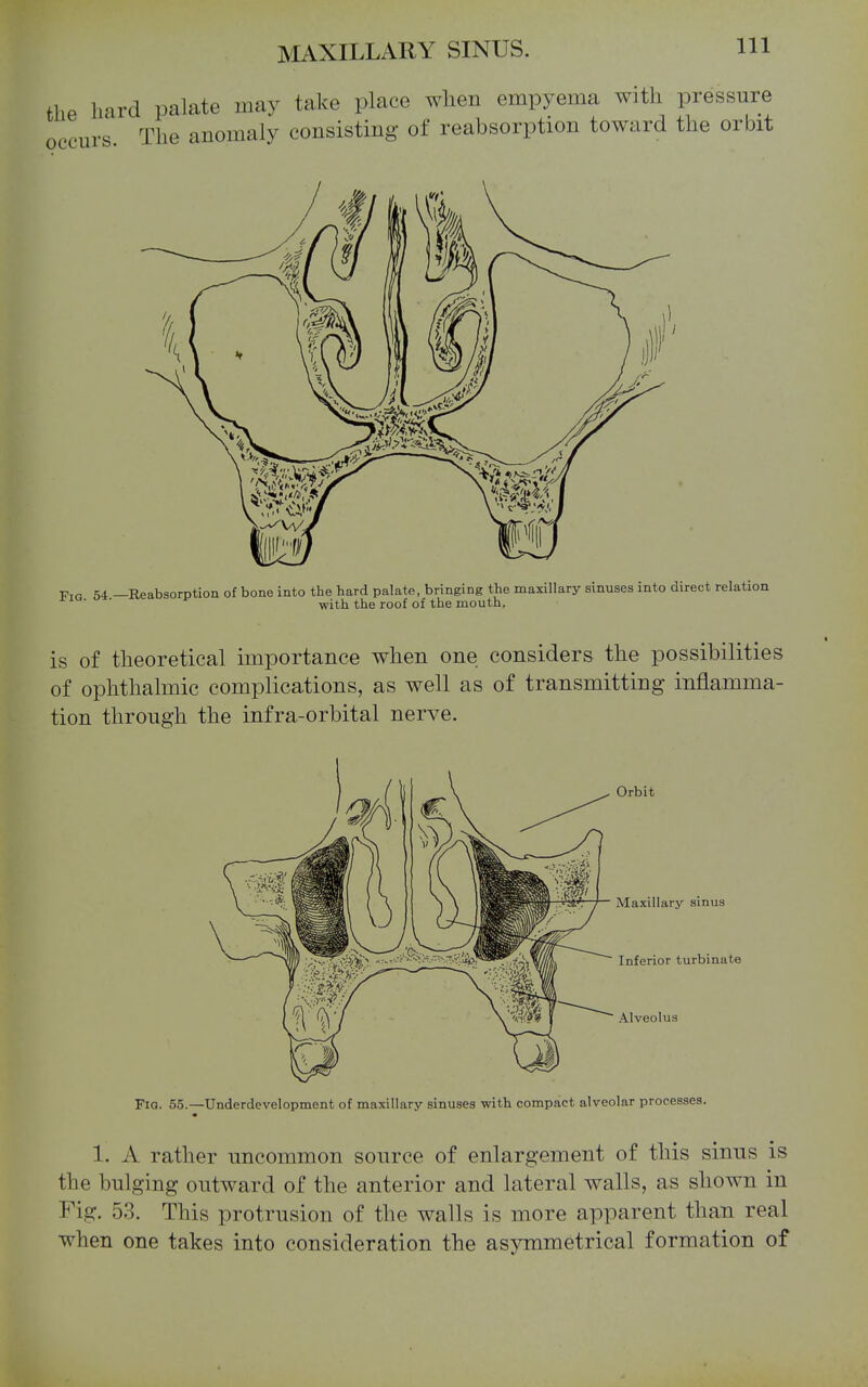 Kio 64 —Reabsorption of bone into the hard palate, bringing the maxillary sinuses into direct relation ■ with the roof of the mouth. is of theoretical importance when one considers the possibilities of ophthalmic complications, as well as of transmitting inflamma- tion through the infra-orbital nerve. Orbit Maxillary sinus Inferior turbinate Alveolus Fio. 55.—Underdevelopment of maxillary sinuses with compact alveolar processes. 1. A rather uncommon source of enlargement of this sinus is the bulging outward of the anterior and lateral walls, as shown in Fig. 53. This protrusion of the walls is more apparent than real when one takes into consideration the asymmetrical formation of