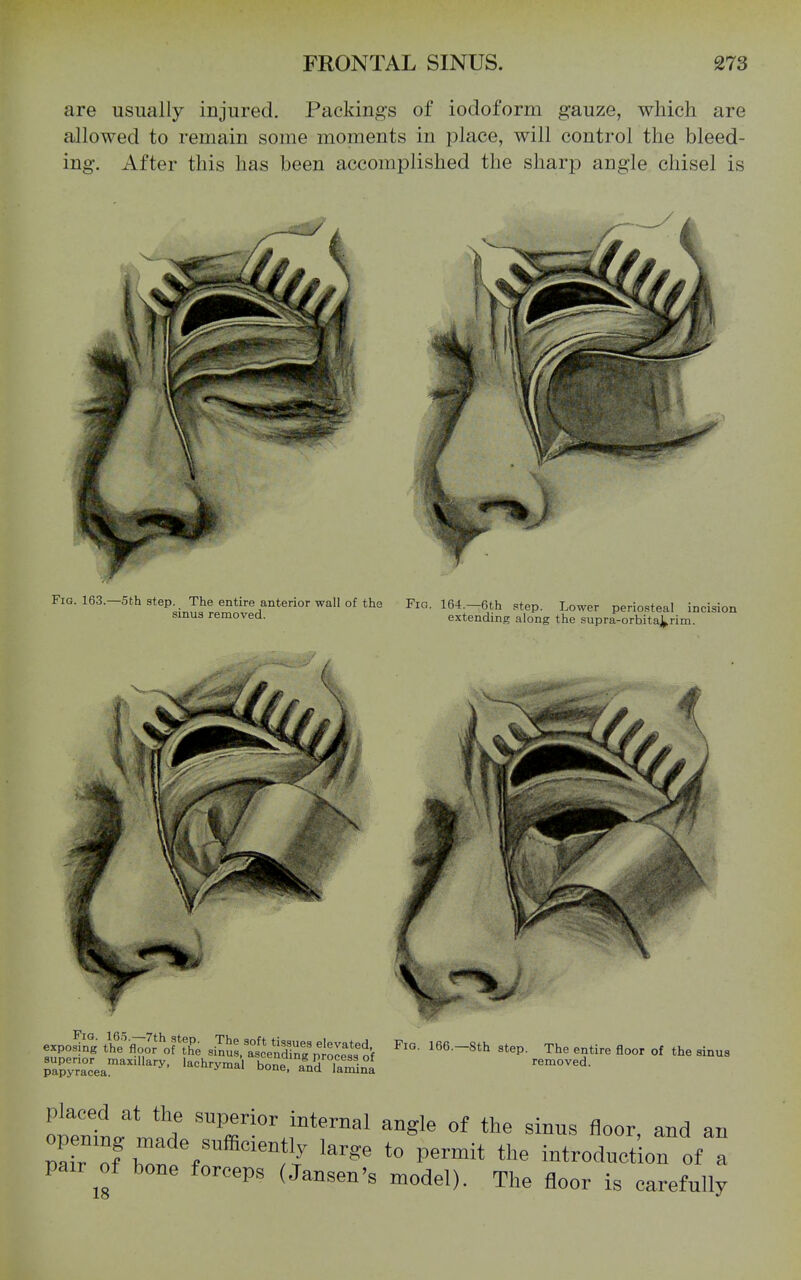 are usually injured. Packings of iodoform gauze, which are allowed to remain some moments in place, will control the bleed- After this has been accomplished the sharp angle chisel is mg. 5- Fig. 163.-5t.h Step. . The entire anterior wall of the Fig. 164.-6th step. Lower periosteal incision sinus removed. extending along the supra-orhitaVrim. irif ^^^'flr'M'^ --ratVilrnrproressIf '^^^ ^-ti- fl-' oi the sinus papyracea!^''^' ^'''^'y^^^ bone, and la^nl placed at the superior internal angle of the sinus floor, and an pair'^f bTne'fr^'^11^ ''''' ^^^^^^ introduction of a pair^of bone forceps (Jansen's model). The floor is carefully