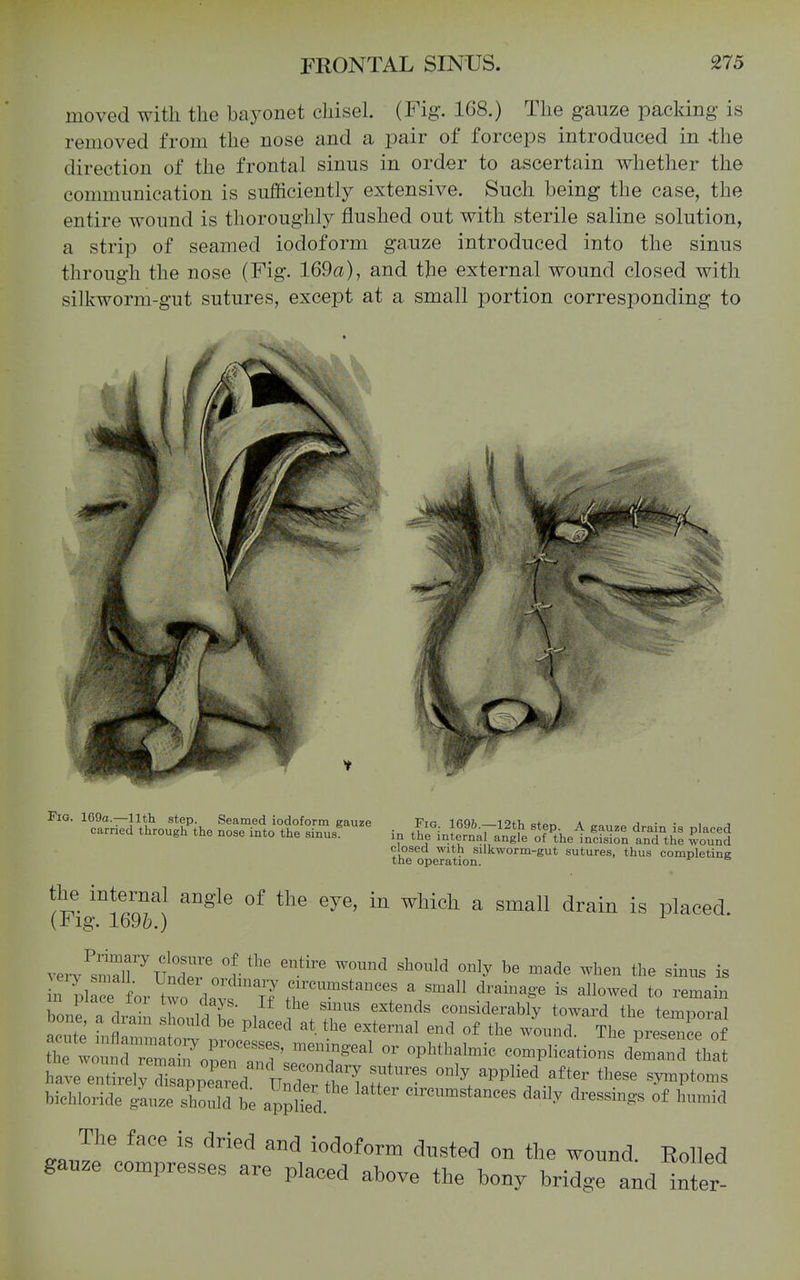 moved with the bayonet chisel. (Fig-. 168.) The gauze packing is removed from the nose and a pair of forceps introduced in .the direction of the frontal sinus in order to ascertain whether the communication is sufficiently extensive. Such being the case, the entire wound is thoroughly flushed out with sterile saline solution, a strip of seamed iodoform gauze introduced into the sinus through the nose (Fig. 169a), and the external wound closed with silkworm-gut sutures, except at a small portion corresponding to Fig. 169a.—11th step. Seamed iodoform gauze carried through the nose into the sinus. . Fig. 169&.—12th step. A gauze drain is placed in the internal angle of the incision and the wound closed with silkworm-gut sutures, thus completing the operation. ™!fr,?J °^ ''^ 'ye, in which a small drain is placed. (Fig. 1696.) .-erJ'^^r'llT' °v ''^ <y ^0 «3e when the sinus is ZJ: T, , ,. f ^' ^^ extmdB considerably toward the temDoral bone, a dram should be placed at the external end of the wound The preseT of h^ w»; dr 7oSrZ' ^7'=^'  e„.p.icatio'sXrr ha have e^tai;Ts ;pered urdrfh/T ^p^^^ ^y™p'-^ bichloride gauze sZdd be appjfed <=™™sta„ces daily dressings of humid The face is dried and iodoform dnsted on the wonnd Rolled ganze compresses are placed above the bony bridge and inter