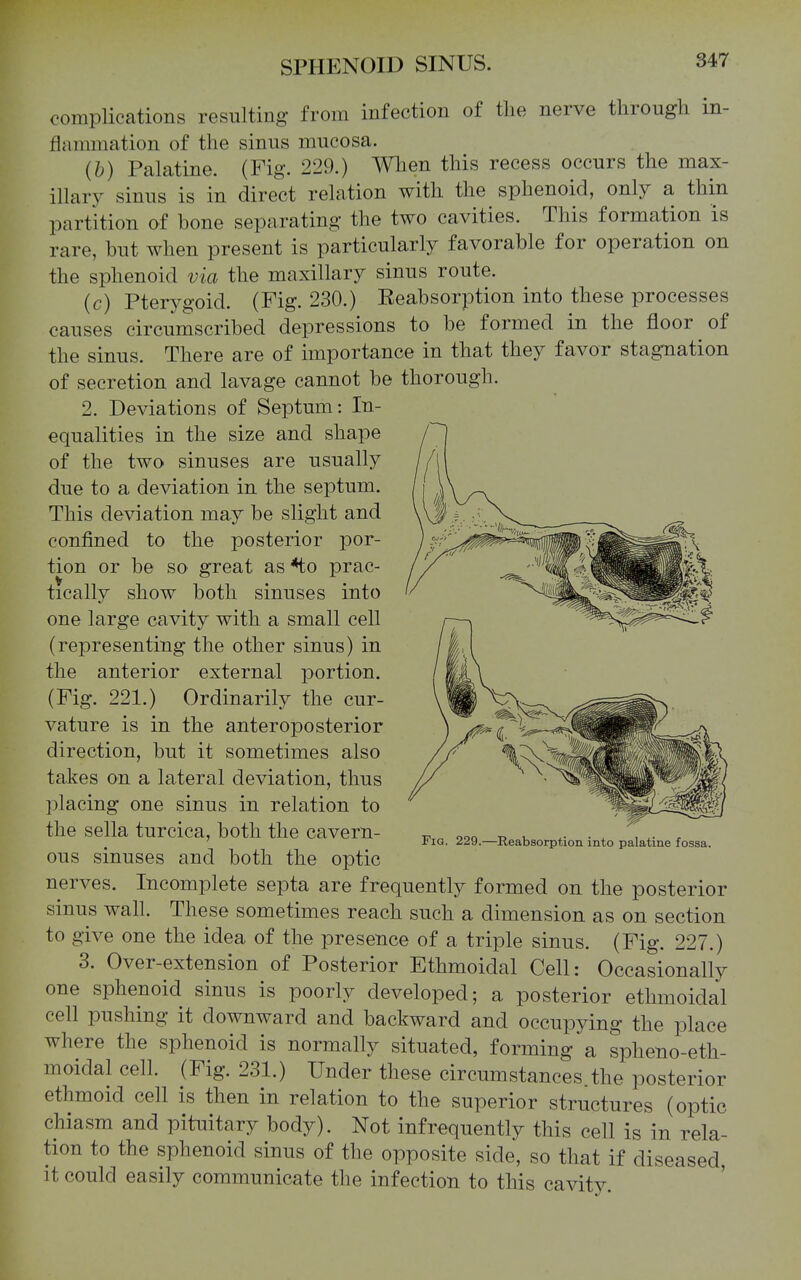 complications resulting from infection of the nerve through in- flammation of the sinus mucosa. (b) Palatine. (Fig. 229.) Wlien this recess occurs the max- illary sinus is in direct relation with the sphenoid, only a thin partition of bone separating the two cavities. This formation is rare, but when present is particularly favorable for operation on the sphenoid via the maxillary sinus route. (c) Pterygoid. (Fig. 230.) Eeabsorption into these processes causes circumscribed depressions to be formed in the floor of the sinus. There are of importance in that they favor stagnation of secretion and lavage cannot be thorough. 2. Deviations of Septum: In- equalities in the size and shape of the two sinuses are usually due to a deviation in the septum. This deviation may be slight and confined to the posterior por- tion or be so great as *to prac- tically show both sinuses into one large cavity with a small cell (representing the other sinus) in the anterior external portion. (Fig. 221.) Ordinarily the cur- vature is in the anteroposterior direction, but it sometimes also takes on a lateral deviation, thus placing one sinus in relation to the sella turcica, both the cavern- ous sinuses and both the optic nerves. Incomplete septa are frequently formed on the posterior sinus wall. These sometimes reach such a dimension as on section to give one the idea of the presence of a triple sinus. (Fig. 227.) 3. Over-extension of Posterior Ethmoidal Cell: Occasionally one sphenoid sinus is poorly developed; a posterior ethmoidal cell pushing it downward and backward and occupying the place where the sphenoid is normally situated, forming a spheno-etli- moidal cell. (Fig. 231.) Under these circumstances the posterior ethmoid cell is then in relation to the superior structures (optic chiasm and pituitary body). Not infrequently this cell is in rela- tion to the sphenoid sinus of the opposite side, so that if diseased, it could easily communicate the infection to this cavity. Fig. 229.—Reabsorption into palatine fossa.