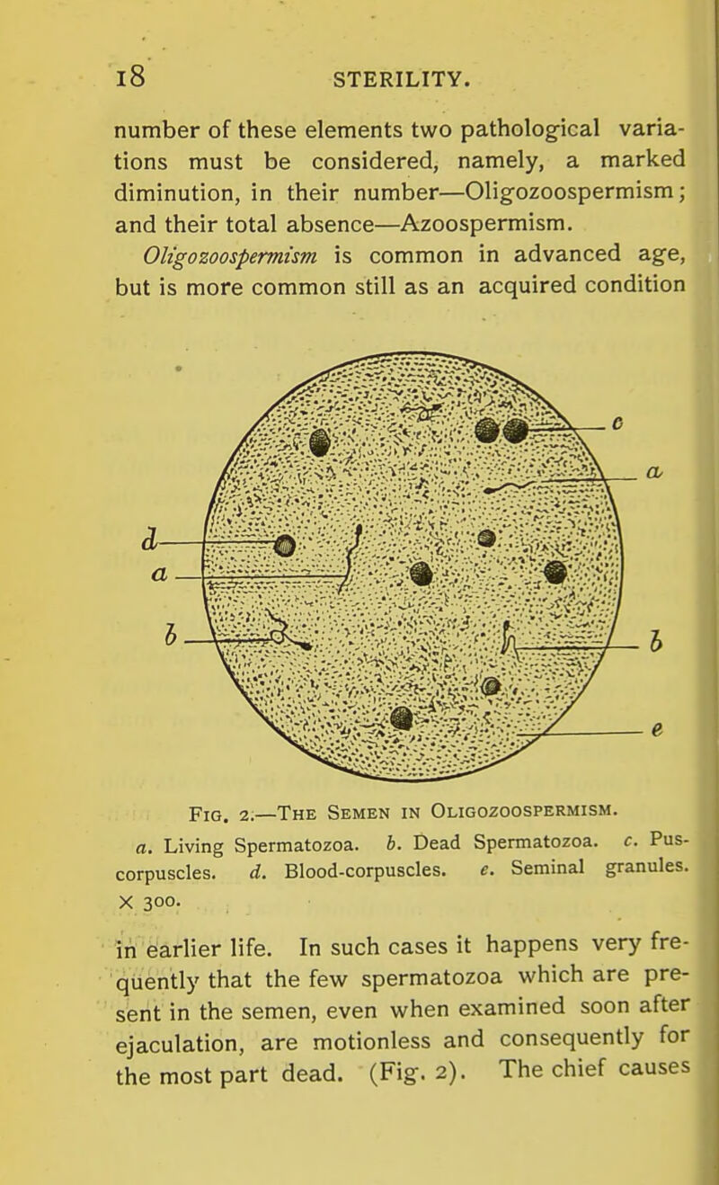 number of these elements two patholog-ical varia- tions must be considered, namely, a marked diminution, in their number—Olig-ozoospermism; and their total absence—Azoospermism. Oligozoospermism is common in advanced age, but is more common still as an acquired condition Fig. 2;—The Semen in Oligozoospermism. a. Living Spermatozoa, b. Dead Spermatozoa, c. Pus- corpuscles, d. Blood-corpuscles. e. Seminal granules. X 300. in Earlier life. In such cases it happens very fre- quently that the few spermatozoa which are pre- sent in the semen, even when examined soon after ejaculation, are motionless and consequently for the most part dead. (Fig. 2). The chief causes