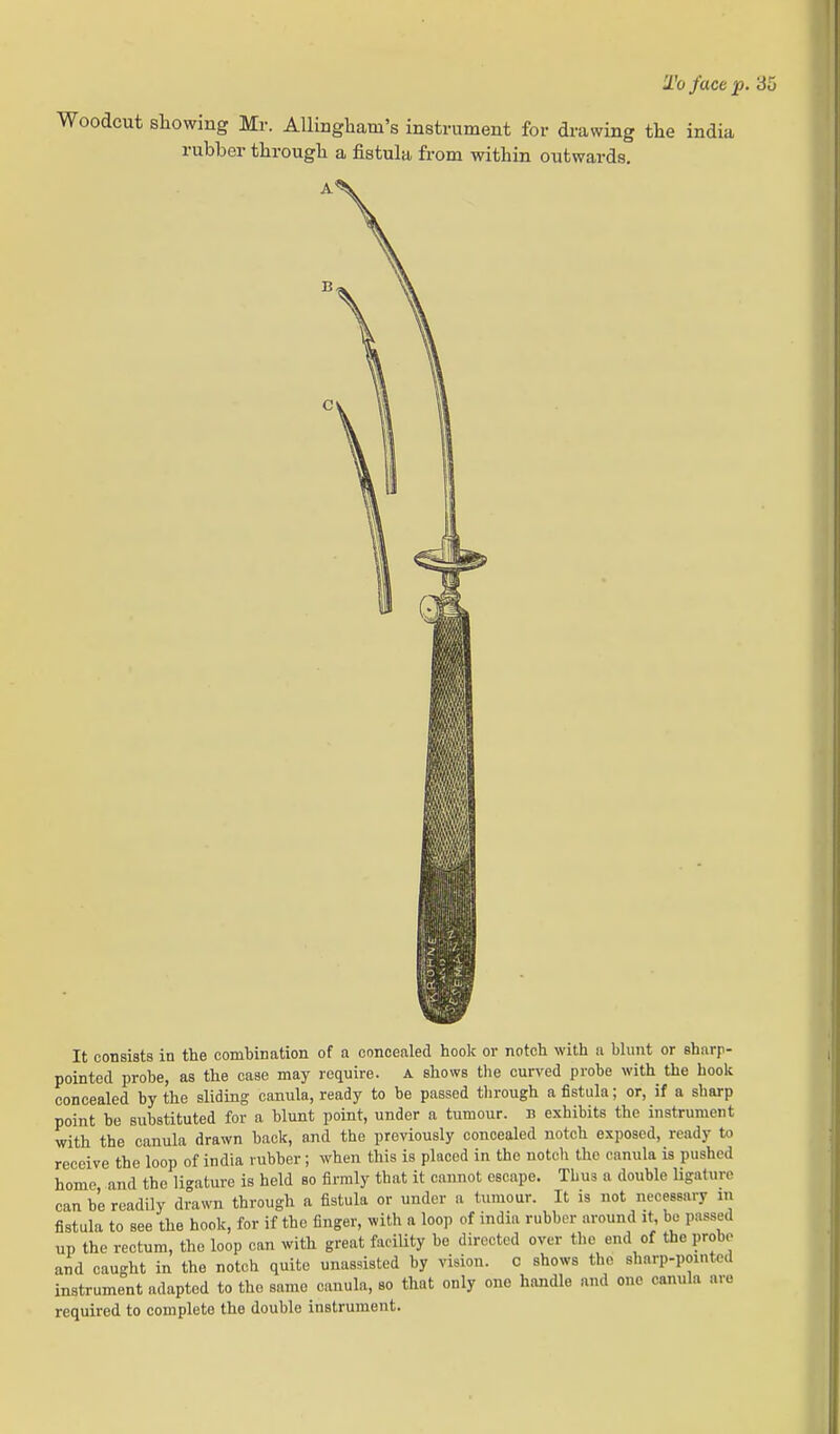 To face p. 35 Woodcut showing Mr. Allingham's instrument for drawing tlie india rubber througb a fistula from within outwards. It consists in the combination of a concealed hook or notch with a blunt or eharp- pointed probe, as the case may require, a shows the curved probe with the hook concealed by the sliding canula, ready to be passed through a fistula; or, if a sharp point be substituted for a blunt point, under a tumour, i? exhibits the instrument with the canula drawn back, and the previously concealed notch exposed, ready to receive the loop of india rubber; when this is placed in the notch the canula is pushed home and the ligature is held so firmly that it cannot escape. Thus a double ligature can be readily drawn through a fistula or under a tumour. It is not necessary m fistula to see the hook, for if the finger, with a loop of india rubber around it, bo passed up the rectum, the loop can with great faciUty bo directed over the end of the probe and caught in the notch quite unassisted by vision, c shows the sharp-pointed instrument adapted to the same canula, so that only one handle and one canula are required to complete the double instrument.