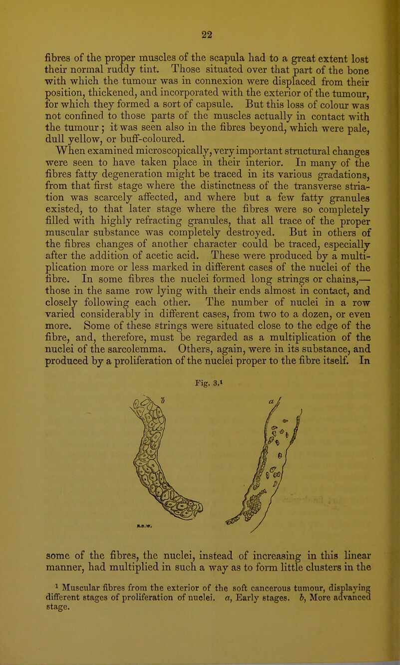fibres of the proper muscles of the scapula had to a great extent lost their normal ruddy tint. Those situated over that part of the bone with which the tumour was in connexion were displaced from their position, thickened, and incorporated with the exterior of the tumour, for which they formed a sort of capsule. But this loss of colour was not confined to those parts of the muscles actually in contact with the tumour ; it was seen also in the fibres beyond, which were pale, dull yellow, or buff-coloured. When examined microscopically, very important structural changes were seen to have taken place in their interior. In many of the fibres fatty degeneration might be traced in its various gradations, from that first stage where the distinctness of the transverse stria- tion was scarcely affected, and where but a few fatty granules existed, to that later stage where the fibres were so completely filled with highly refracting granules, that all trace of the proper muscular substance was completely destroyed. But in others of the fibres changes of another character could be traced, especially after the addition of acetic acid. These were produced by a multi- plication more or less marked in different cases of the nuclei of the fibre. In some fibres the nuclei formed long strings or chains,— those in the same row lying with their ends almost in contact, and closely following each other. The number of nuclei in a row varied considerably in different cases, from two to a dozen, or even more. Some of these strings were situated close to the edge of the fibre, and, therefore, must be regarded as a multiplication of the nuclei of the sarcolemma. Others, again, were in its substance, and produced by a proliferation of the nuclei proper to the fibre itself. In Fig. 3.» some of the fibres, the nuclei, instead of increasing in this linear manner, had multiplied in such a way as to form little clusters in the 1 Muscular fibres from the exterior of the soft cancerous tumour, displaying different stages of proliferation of nuclei, a, Early stages, b, More advanced stage.