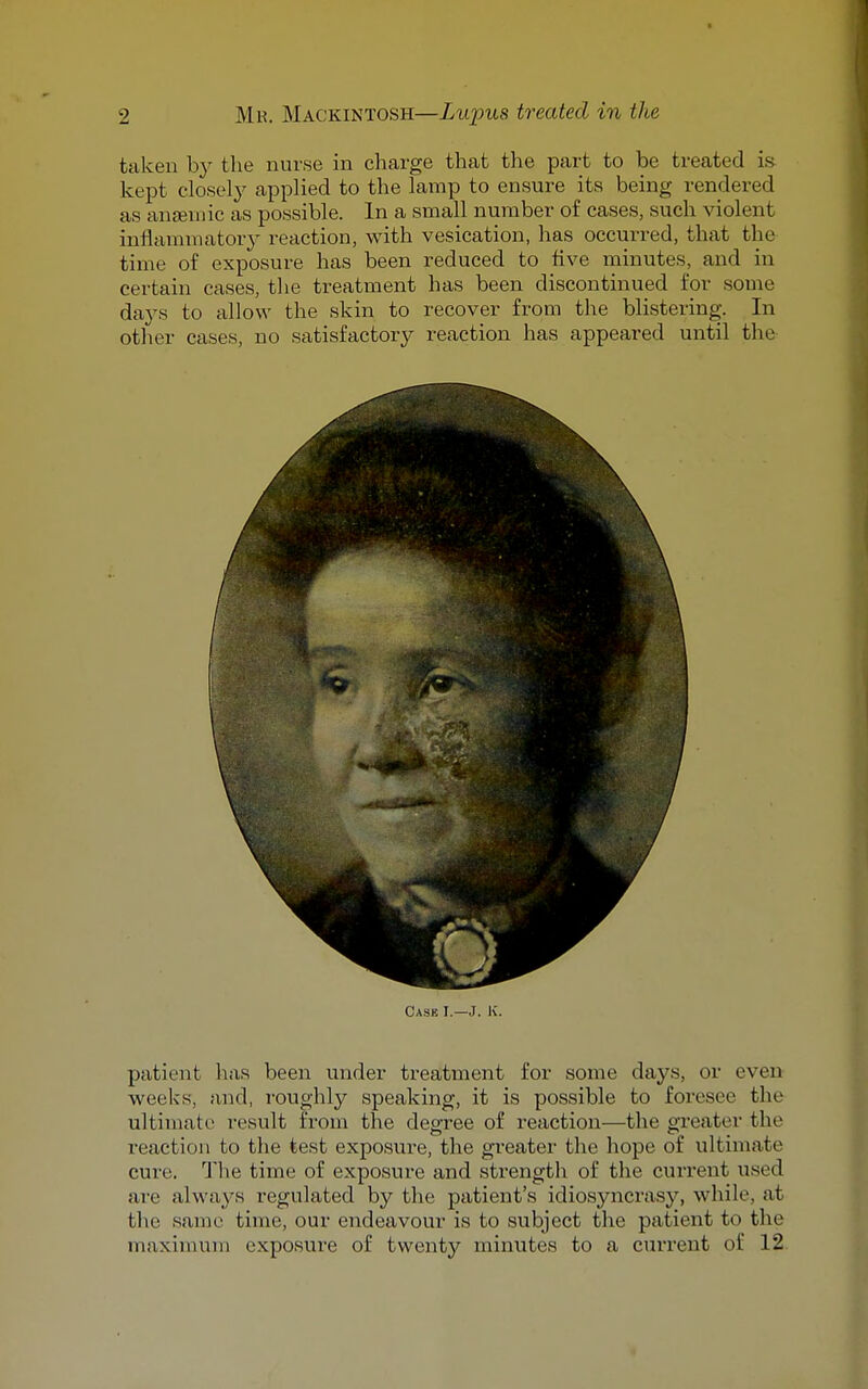 taken by the nurse in charge that the part to be treated is kept closelj^ applied to the lamp to ensure its being rendered as anfeniic as possible. In a small number of cases, such violent inflammatory reaction, with vesication, has occurred, that the time of exposure has been reduced to five minutes, and in certain cases, the treatment has been discontinued for some days to allow the skin to recover from the blistering. In other cases, no satisfactory reaction has appeared until the Case I.—J. K. patient has been under treatment for some days, or even weeks, and, roughly speaking, it is possible to foresee the ultimate result from the degree of reaction—the greater the reaction to the test exposure, the greater the hope of ultimate cure. The time of exposure and strength of the current used are always regulated by the patient's idiosyncrasy, while, at the same time, our endeavour is to subject the patient to the maximum exposure of twenty minutes to a current of 12