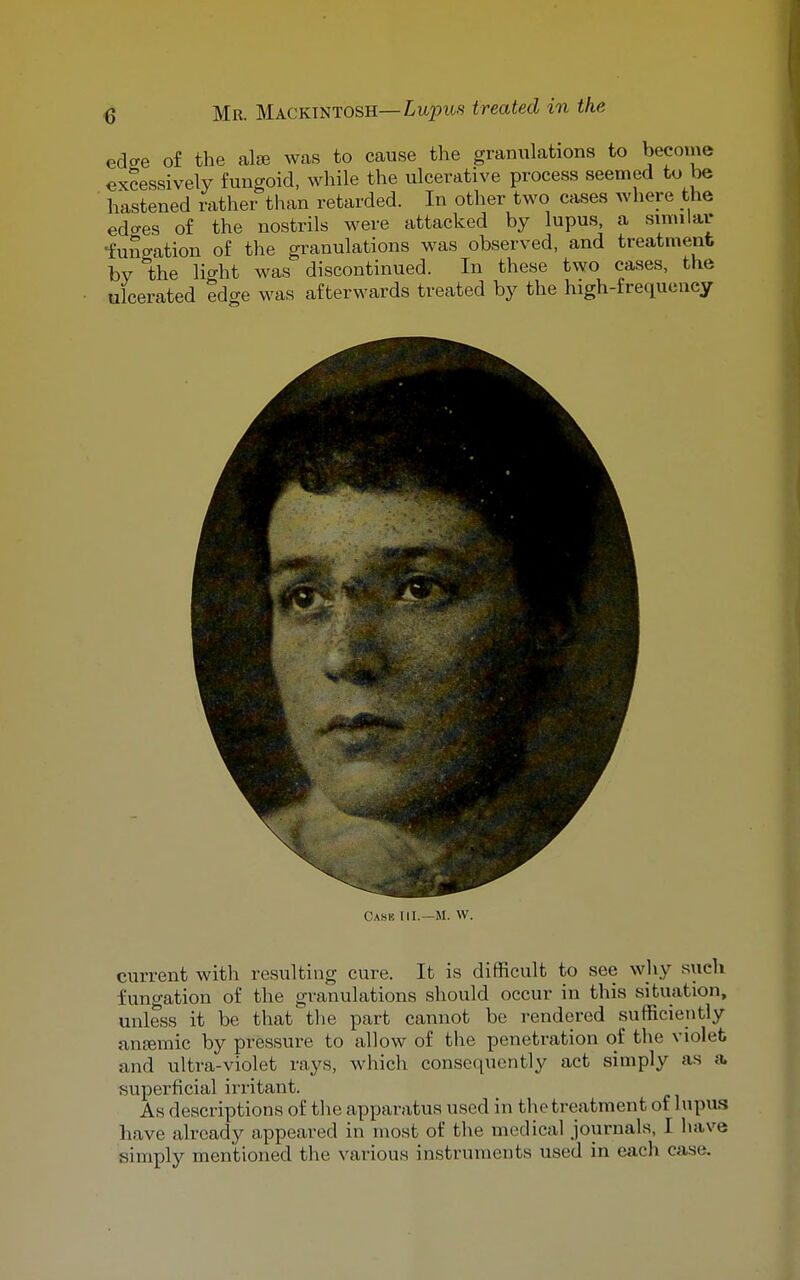 edo-e of the alfe was to cause the granulations to become excessively fungoid, while the ulcerative process seemed to be hastened rather than retarded. In other two cases where the edo-es of the nostrils were attacked by lupus, a similar •fungation of the granulations was observed, and treatment by the light was discontinued. In these two cases, the ulcerated edge was afterwards treated by the high-frequency Cask HI.—M. W. current with resulting cure. It is difficult to see wliy such fungation of the granulations should occur in this situation, unless it be that^the part cannot be rendered sufficiently antemic by pressure to allow of the penetration of the violet and ultra-violet rays, which consequently act simply as a. superficial irritant. As descriptions of the apparatus used in thetreatment of lupus have already appeared in most of the medical journals, I liave simply mentioned the various instruments used in each case.