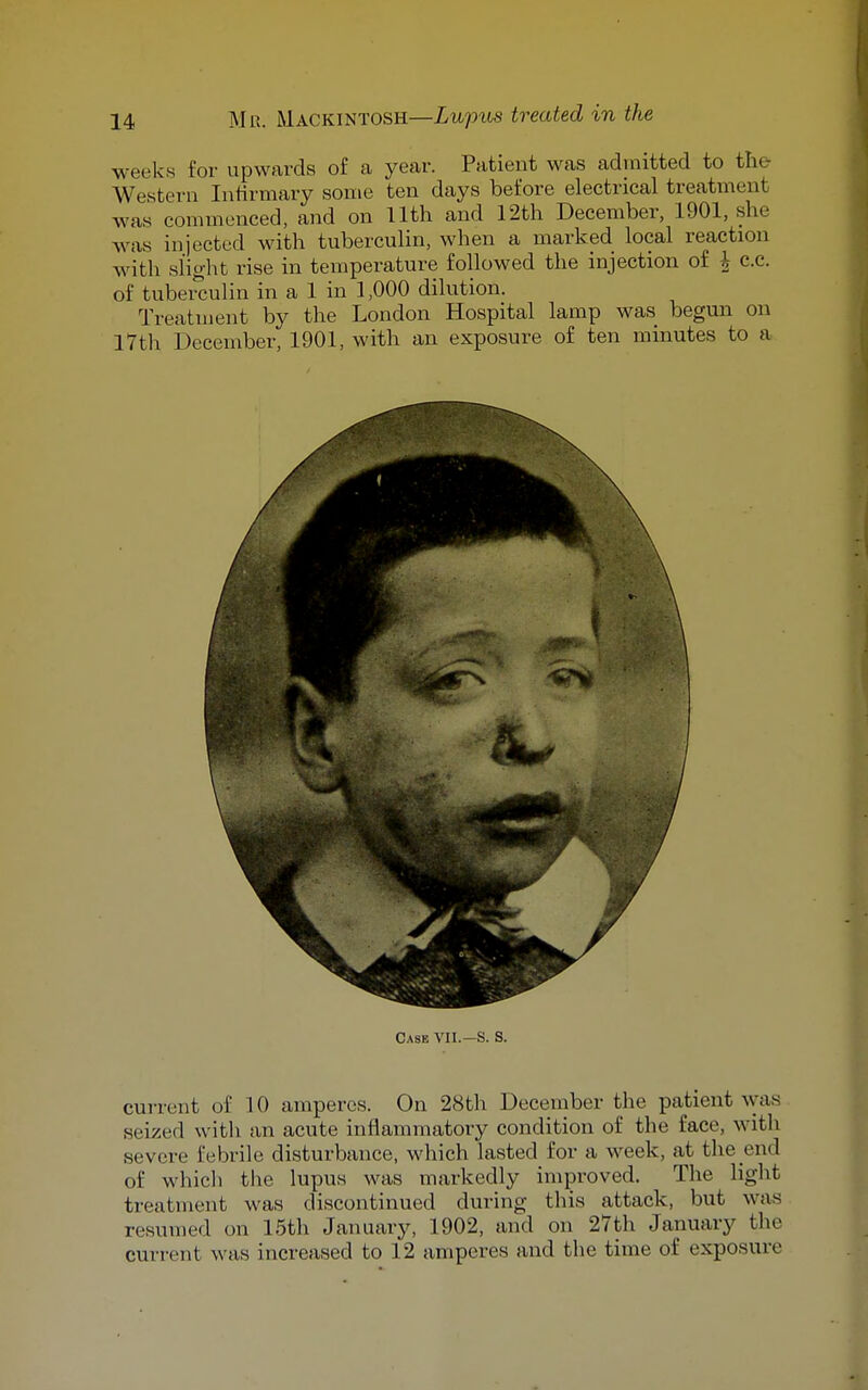 weeks for upwards of a year. Patient was admitted to the Western Infirmary some ten days before electrical treatment was commenced, and on Uth and 12th December, 1901, she was injected with tuberculin, when a marked local reaction with slight rise in temperature followed the injection of \ e.c. of tuberculin in a 1 in 1,000 dilution. Treatment by the London Hospital lamp was begun on 17th December, 1901, with an exposure of ten minutes to a Case Vn.—S. S. cui-rent of 10 amperes. On 28th December the patient was seized with an acute inflammatory condition of the face, with severe febrile disturbance, which lasted for a week, at the end of which the lupus was markedly improved. The light treatment was discontinued during this attack, but was resumed on 15th January, 1902, and on 27th January the current was increased to 12 amperes and the time of exposure