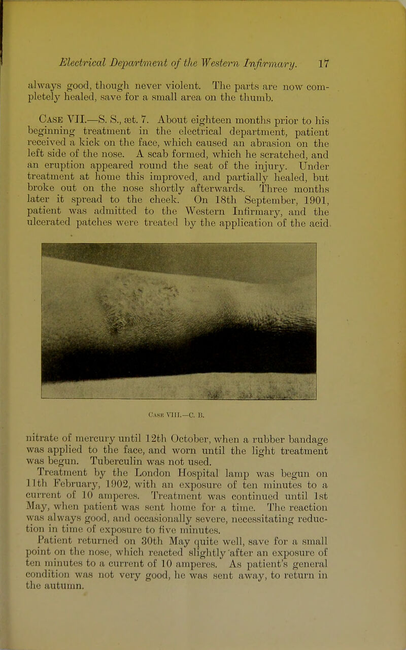 always good, though never violent. Tl^e parts are now com- pletely healed, save for a small area on the tliumb. Case VII.—S. S., sat. 7. About eighteen months prior to his beginning treatment in the electrical department, patient received a kick on the face, which caused an abrasion on the left side of the nose. A scab formed, which he scratched, and an eruption appeared round the seat of the injury. Under treatment at home this improved, and partially healed, but broke out on the nose shortly afterwards. Three months later it spread to the cheek. On 18th September, 1901, patient was admitted to the Western Infirmary, and the ulcerated patches were treated by the application of the acid. Cask Vni.—C. B. nitrate of mercury until 12th October, when a rubber bandage was applied to the face, and worn until the light treatment was begun. Tuberculin was not used. Treatment by the London Hospital lamp was begun on 11th February, 1902, with an exposure of ten minutes to a current of 10 amperes. Treatment was continued until 1st May, when patient was sent home for a time. The reaction was always good, and occasionally severe, necessitating reduc- tion in time of exposure to five minutes. Patient returned on 30th May quite well, save for a small point on the nose, which reacted sliglitly after an exposure of ten minutes to a current of 10 amperes. As patient's general condition was not very good, he was sent away, to return in the autumn.