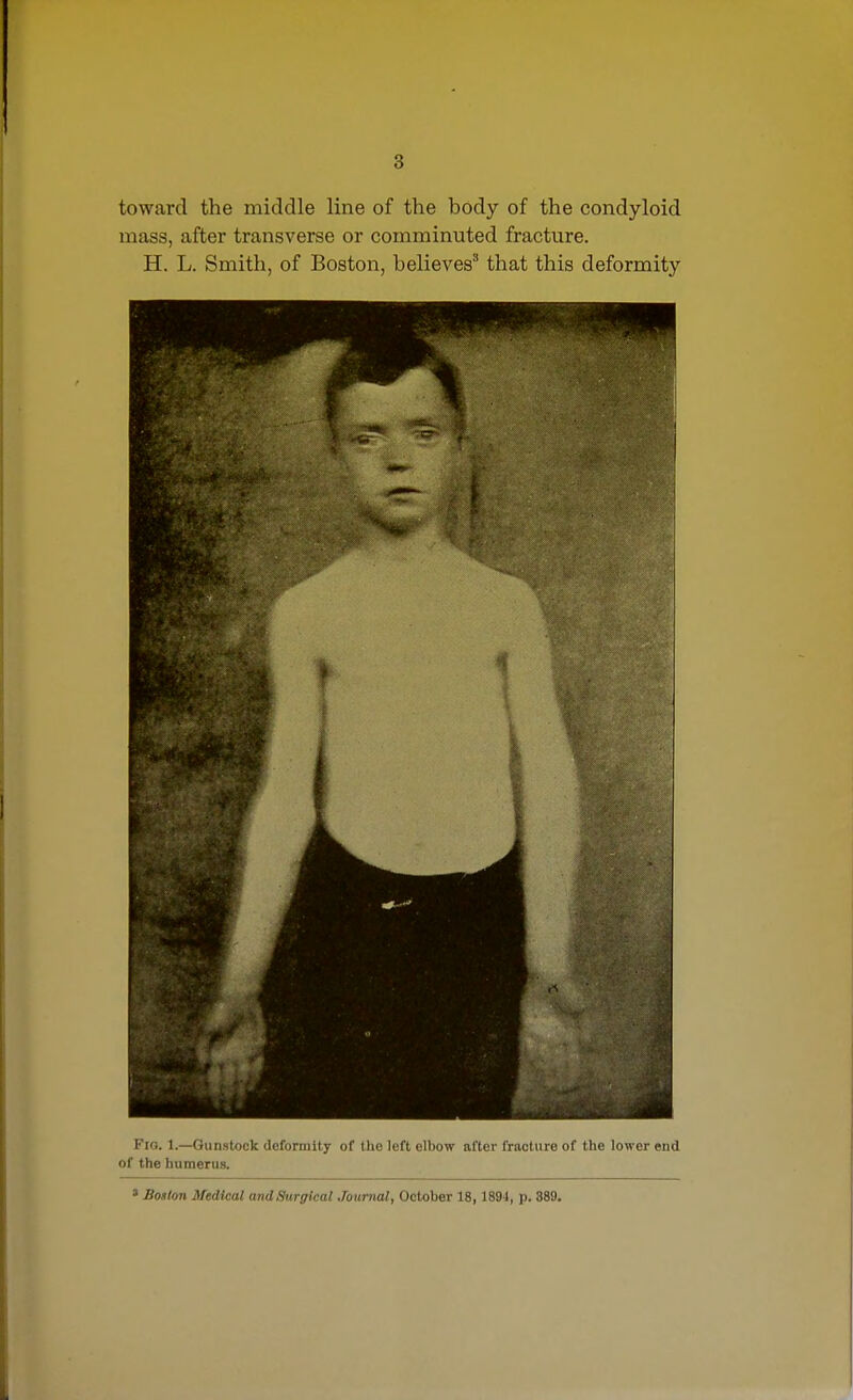 toward the middle line of the body of the condyloid mass, after transverse or comminuted fracture. H. L. Smith, of Boston, believes'' that this deformity Fio. 1—Gunstock deformity of the left elbow after fracture of the lower end of the humerus. ' Boston Medical andSurgical Journal, October 18,1894, p. 889.