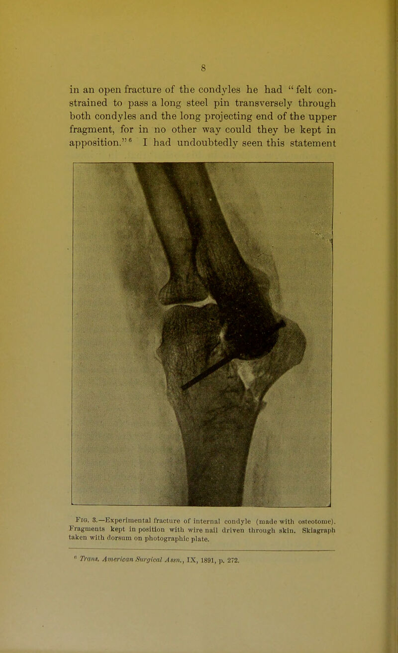 in an open fracture of the condyles he had  felt con- strained to pass a long steel pin transversely through both condyles and the long projecting end of the upper fragment, for in no other way could they be kept in apposition.^ I had undoubtedly seen this statement Fig. 3.—Experimental fracture of internal conilylu (luade with osteotome). Fragments kept in position with wire nail driven through skin. Skiagraph taken with dorsum on photographic plate.