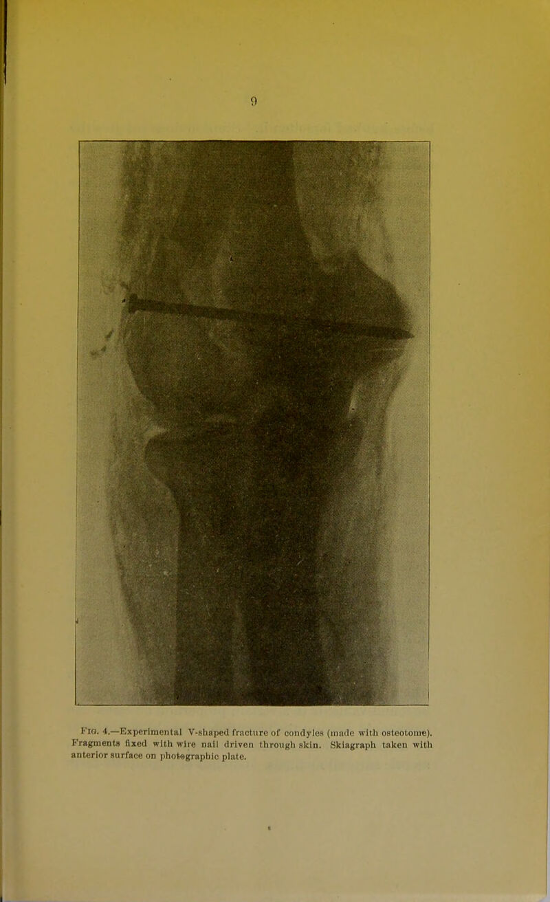 Via. 4.—Experimental V-shaped fracture of condyles (made with osteotome). Fragments fixed with wire nail driven through skin. Skiagraph taken with anterior surface on photographic plate. i