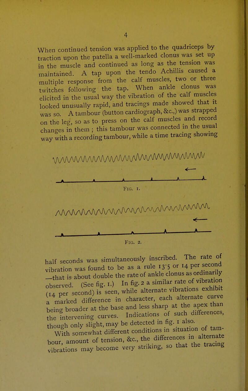 When continued tension was applied to the quadriceps by traction upon the patella a well-marked clonus was set up in the muscle and continued as long as the tension was maintained. A tap upon the tendo Achillis caused a multiple response from the calf muscles, two or three twitches following the tap. When ankle clonus was elicited in the usual way the vibration of the calf muscles looked unusually rapid, and tracings made showed that it was so. A tambour (button cardiograph, &c.,) was strapped on the leg, so as to press on the calf muscles and record changes in them ; this tambour was connected m the usual way with a recording tambour, while a time traang showmg Fig. I. Fig. 2. half seconds was simultaneously inscribed. The rate of vibration was found to be as a rule 13'5 or 14 per second -that is about double the rate of ankle clonus as ordmarily observed. (See fig. i.) In fig. 2 a similar rate of vibration (14 per second) is seen, while alternate vibrations exhibit a marked difference in character, each alternate curve being broader at the base and less sharp at the apex h n the intervening curves. Indications of such differences, though only slight, may be detected in fig. i also. Xl^ somewhat different conditions in situation of ta^^^ bour, amount of tension, &c., the d^^-^-^/^J^ vibrations may become very striking, so that the tracing