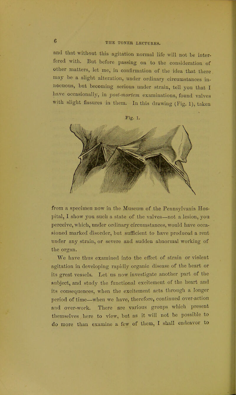 and that without this agitation normal life will not be inter- fered with. But before passing on to the consideration of other matters, let me, in confirmation of the idea that there may be a slight alteration, under ordinary circumstances in- nocuous, but becoming serious under strain, tell you that I have occasionally, in post-mortem examinations, found valves with slight fissures in them. In this drawing (Fig. 1), taken Fig. 1. from a specimen now in the Museum of the Pennsylvania Hos- pital, I show you such a state of the valves—not a lesion, you perceive, which, under ordinary circumstances, would have occa- sioned marked disorder, but sufficient to have produced a rent under any strain, or severe and sudden abnormal working of the organ. We have thus examined into the effect of strain or violent agitation in developing rapidly organic disease of the heart or its great vessels. Let us now investigate another part of the subject, and study the functional excitement of the heart and its consequences, when the excitement acts through a longer period of time—when we have, therefore, continued over-action and over-work. There are various groups which present themselves here to view, but as it will not be possible to do more than examine a few of them, I shall endeavor to