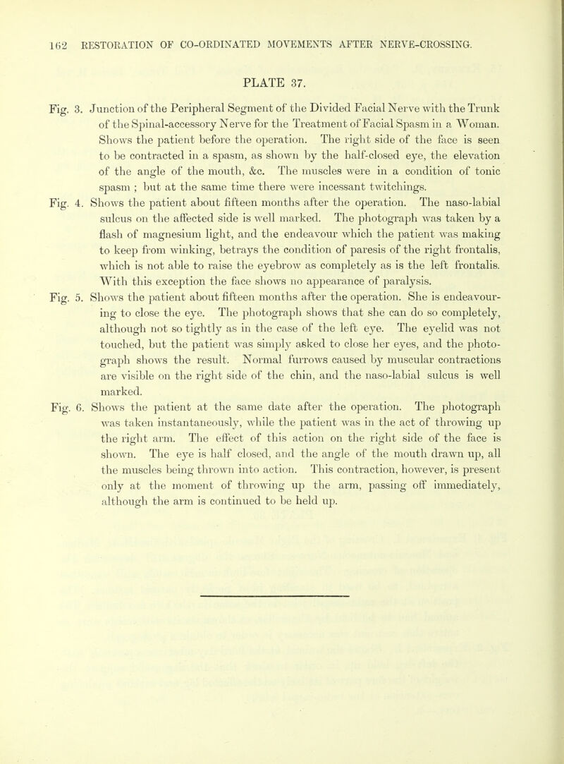PLATE 37. Fig. 3. Junction of the Peripheral Segment of the Divided Facial Nerve with the Trunk of the Spinal-accessory Nerve for the Treatment of Facial Spasm in a Woman. Shows the patient before the operation. The right side of the face is seen to be contracted in a spasm, as shown by the half-closed eye, the elevation of the angle of the mouth, &c. The muscles were in a condition of tonic spasm ; but at the same time there were incessant twitchings. Fig. 4. Shows the patient about fifteen months after the operation. The naso-labial sulcus on the affected side is well marked. The photograph was taken by a flash of magnesium light, and the endeavour which the patient was making to keep from winking, betrays the condition of paresis of the right frontalis, which is not able to raise the eyebrow as completely as is the left frontalis. With this exception the face shows no appearance of paralysis. Fig. 5. Shows the patient about fifteen months after the operation. She is endeavour- ing to close the eye. The photograph shows that she can do so completely, although not so tightly as in the case of the left eye. The eyelid was not touched, but the patient was simply asked to close her eyes, and the photo- graph shows the result. Normal furrows caused by muscular contractions are visible on the right side of the chin, and the naso-labial sulcus is well marked. Fig. 6. Shows the patient at the same date after the operation. The photograph was taken instantaneously, while the patient was in the act of throwing up the right arm. The effect of this action on the right side of the face is shown. The eye is half closed, and the angle of the mouth drawn up, all the muscles being thrown into action. This contraction, however, is present only at the moment of throwing up the arm, passing off immediately, although the arm is continued to be held up.