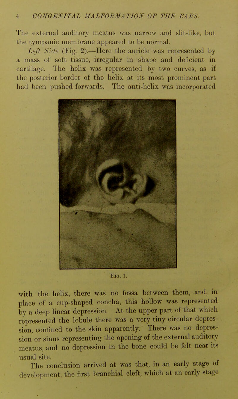 The external auditory meatus was narrow and slit-like, but the tympanic membrane appeared to be normal. Left Side (Fig. 2).—Here the auricle Avas represented by a mass of soft tissue, irregular in shape and deficient in cartilage. The helix was represented by two curves, as if the posterior border of the helix at its most prominent part had been pushed forwards. The anti-helix Avas incorporated iuti. 1. with the helix, there was no fossa between them, and, in place of a cup-shaped concha, this hollow was represented by a deep linear depression. At the upper part of that which represented the lobule there was a very tiny circular depres- sion, confined to the skin apparently. There was no depres- sion or sinus representing the opening of the external auditory meatus, and no depression in the bone could be felt near its usual site. The conclusion arrived at was that, in an early stage of development, the first branchial cleft, which at an early stage