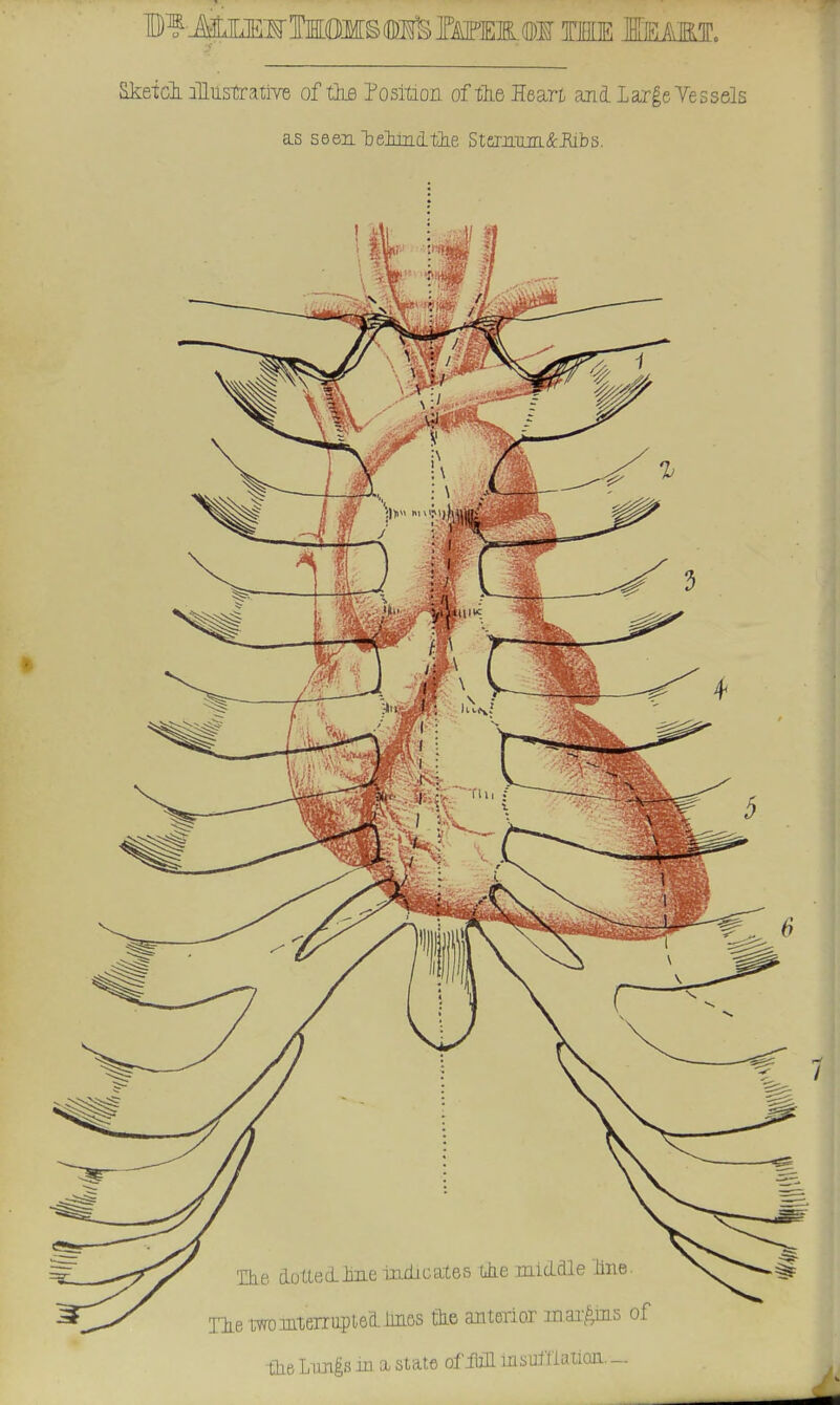 Sketcl alttstrativB of the Position of-file Heart and large Vessels as seen belaudtie StemamOibs. The dottedlae indicates tie middle iine Tie twDintenapted linos tie anterior margins of the Lungs m a state of iiill lusuCfiatQa. _